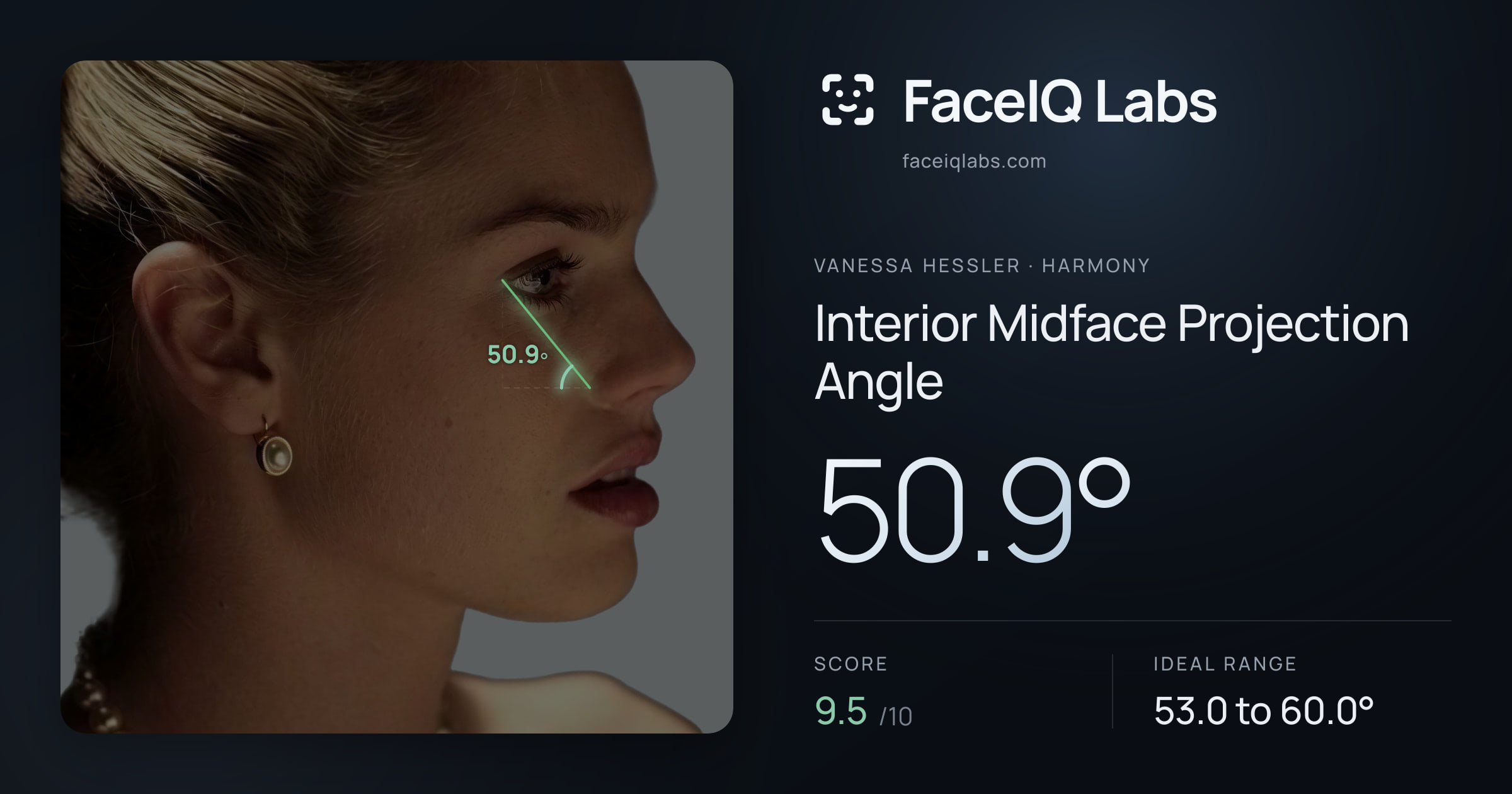 Vanessa Hessler Interior Midface Projection Angle: 50.9°, drawn on the photo