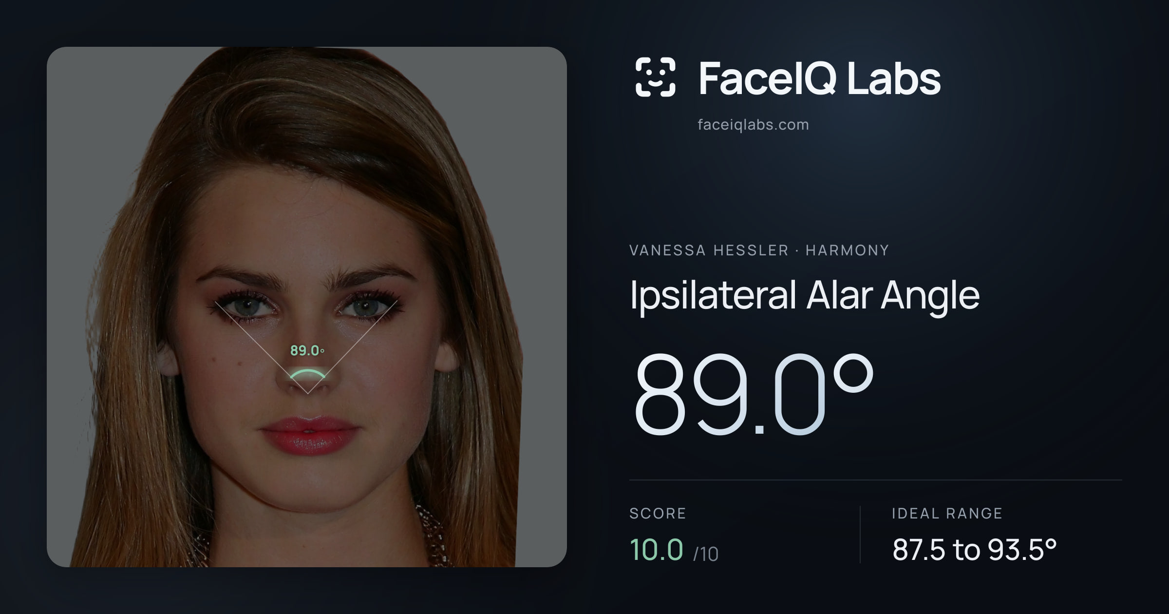 Vanessa Hessler Ipsilateral Alar Angle: 89.0°, drawn on the photo