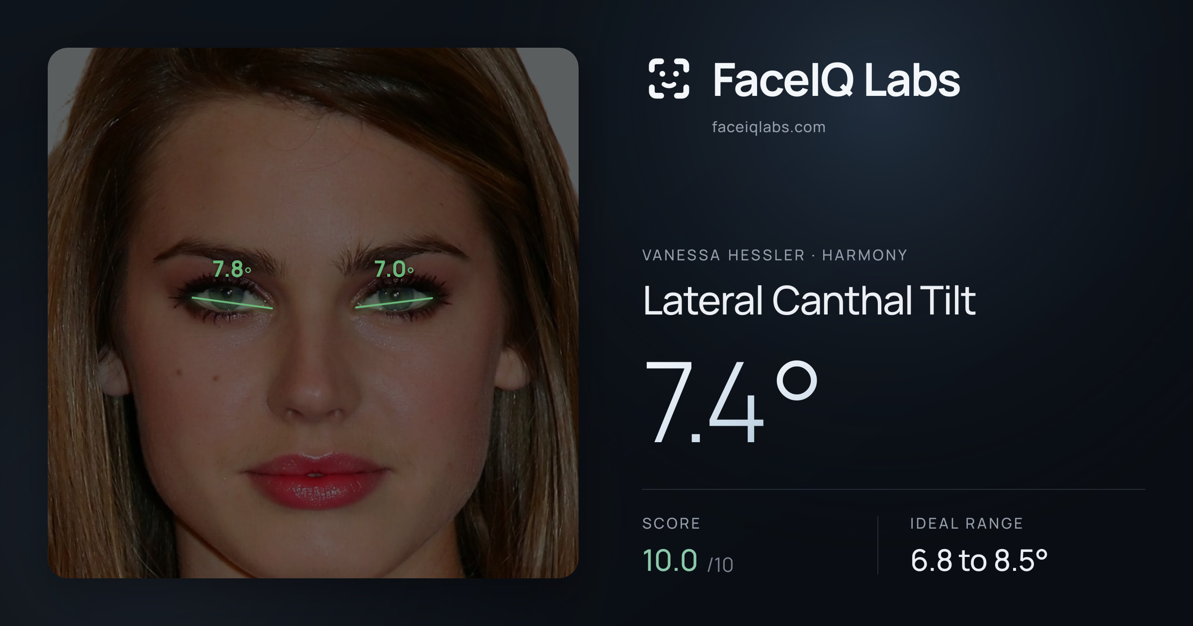 Vanessa Hessler Lateral Canthal Tilt: 7.4°, drawn on the photo