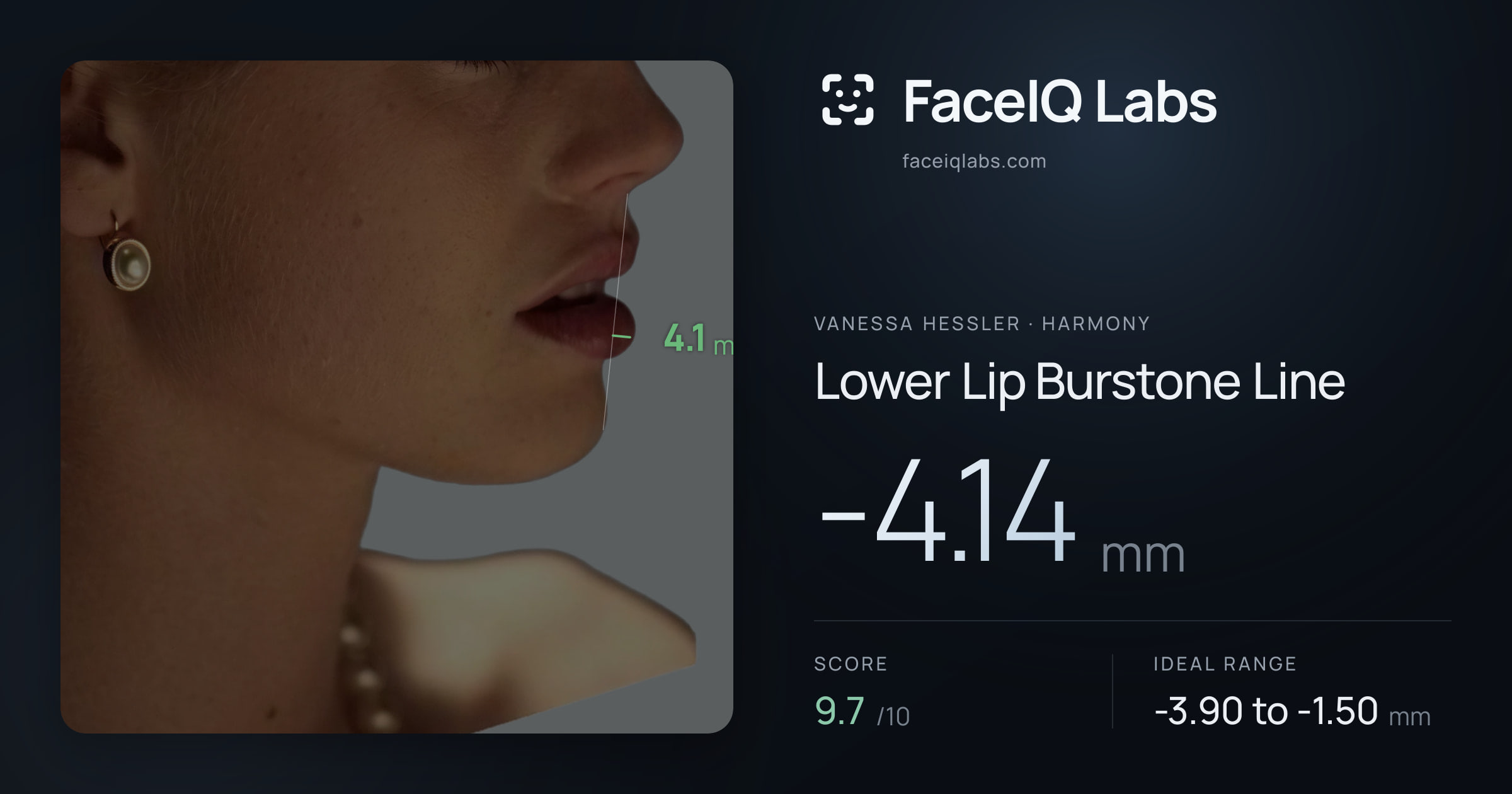 Vanessa Hessler Lower Lip Burstone Line: -4.14mm, drawn on the photo