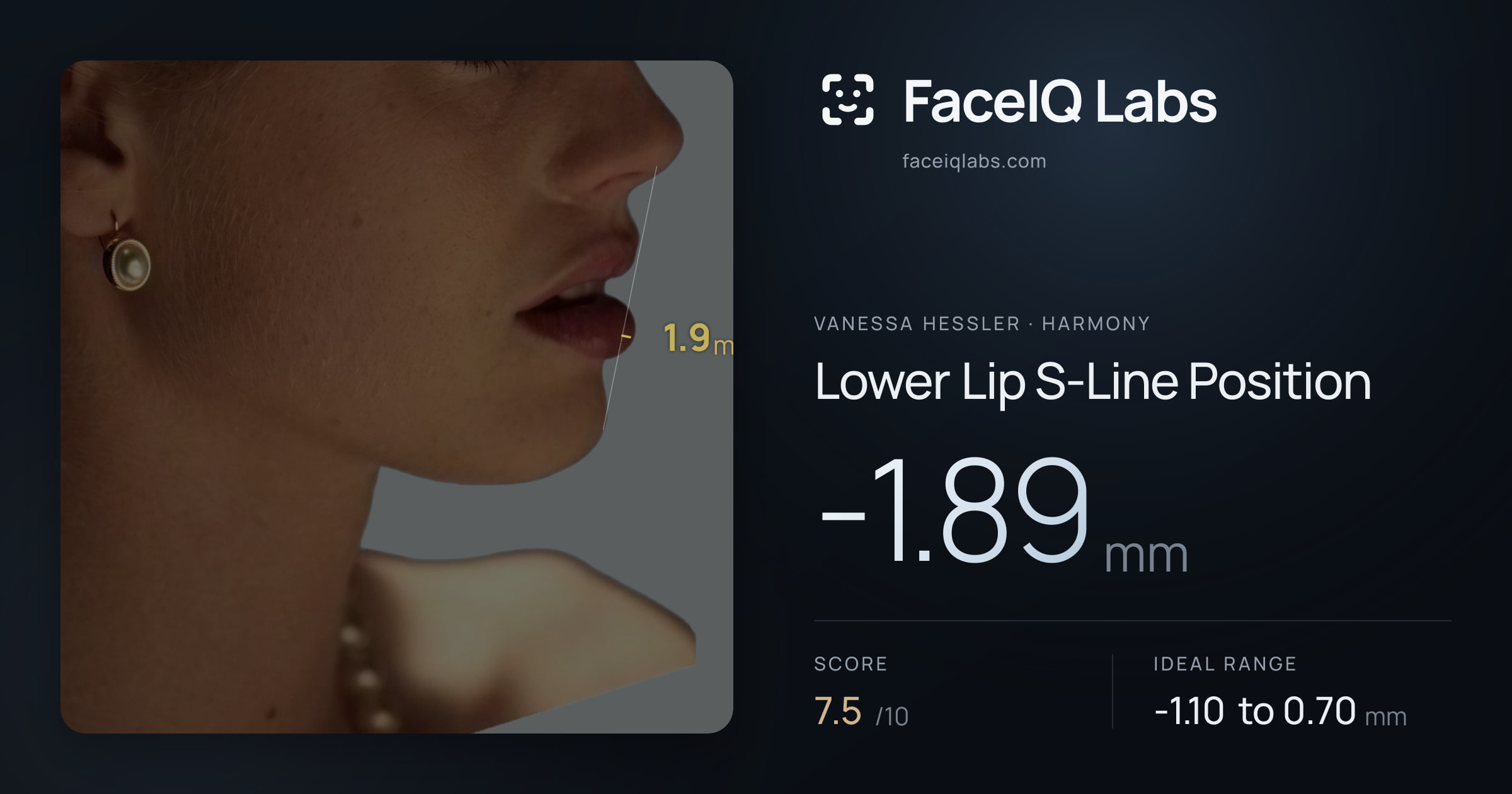 Vanessa Hessler Lower Lip S-Line Position: -1.89mm, drawn on the photo