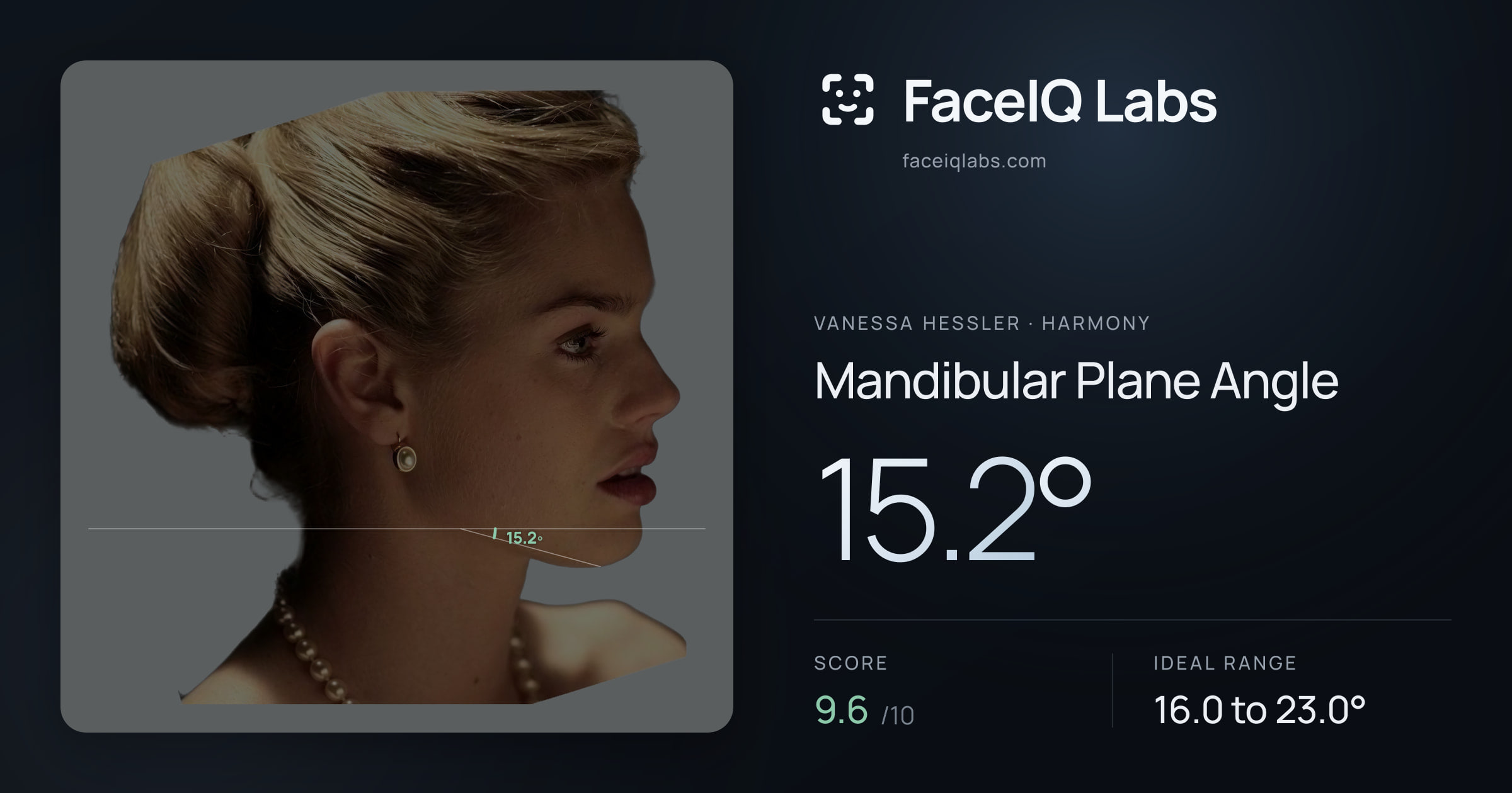 Vanessa Hessler Mandibular Plane Angle: 15.2°, drawn on the photo