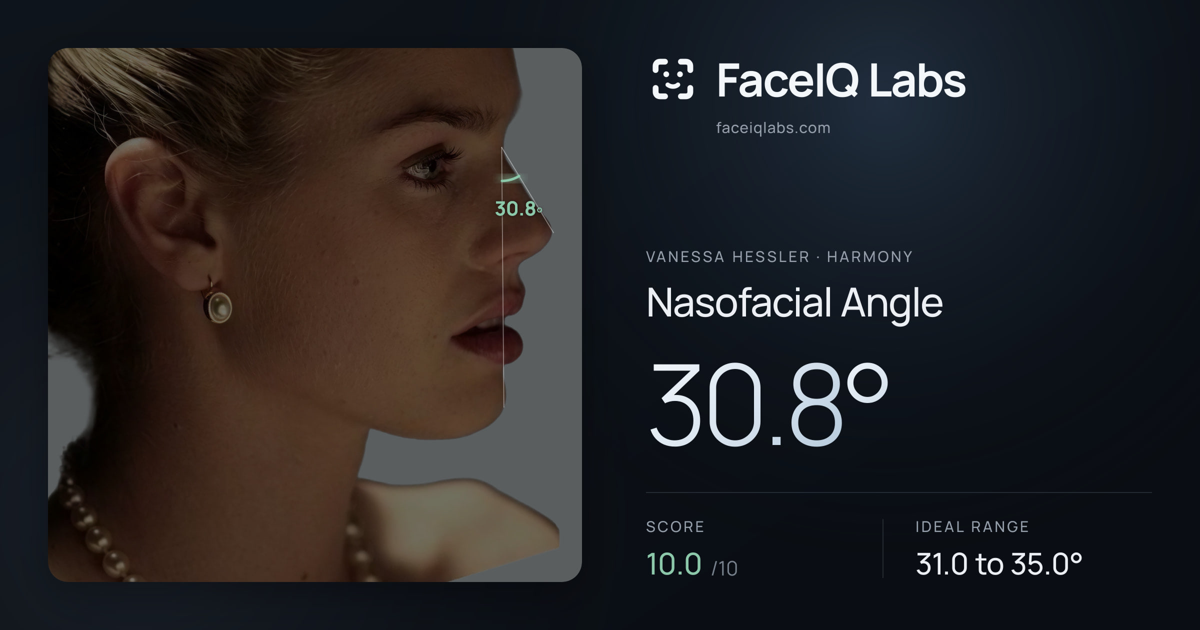 Vanessa Hessler Nasofacial Angle: 30.8°, drawn on the photo