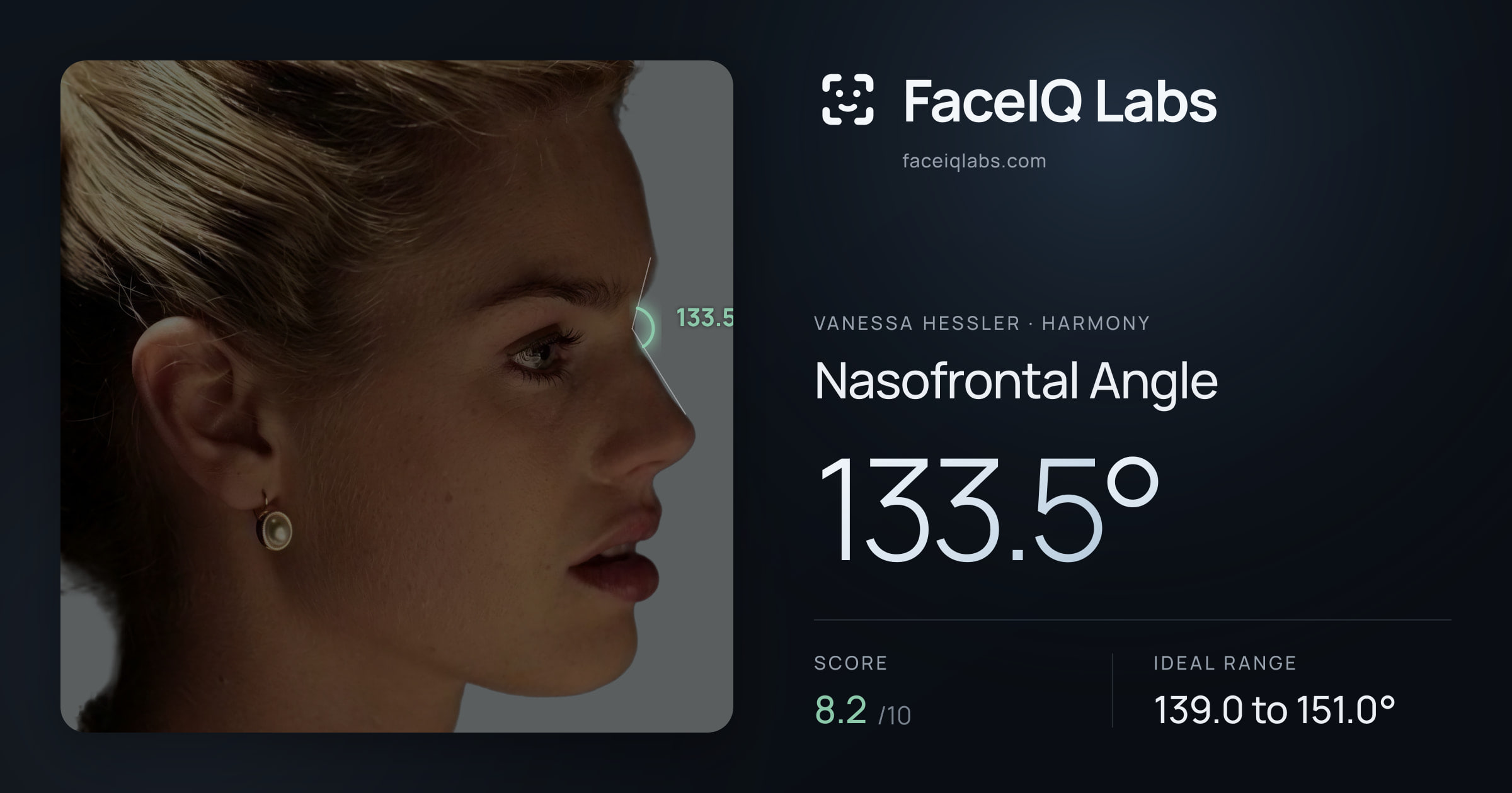 Vanessa Hessler Nasofrontal Angle: 133.5°, drawn on the photo