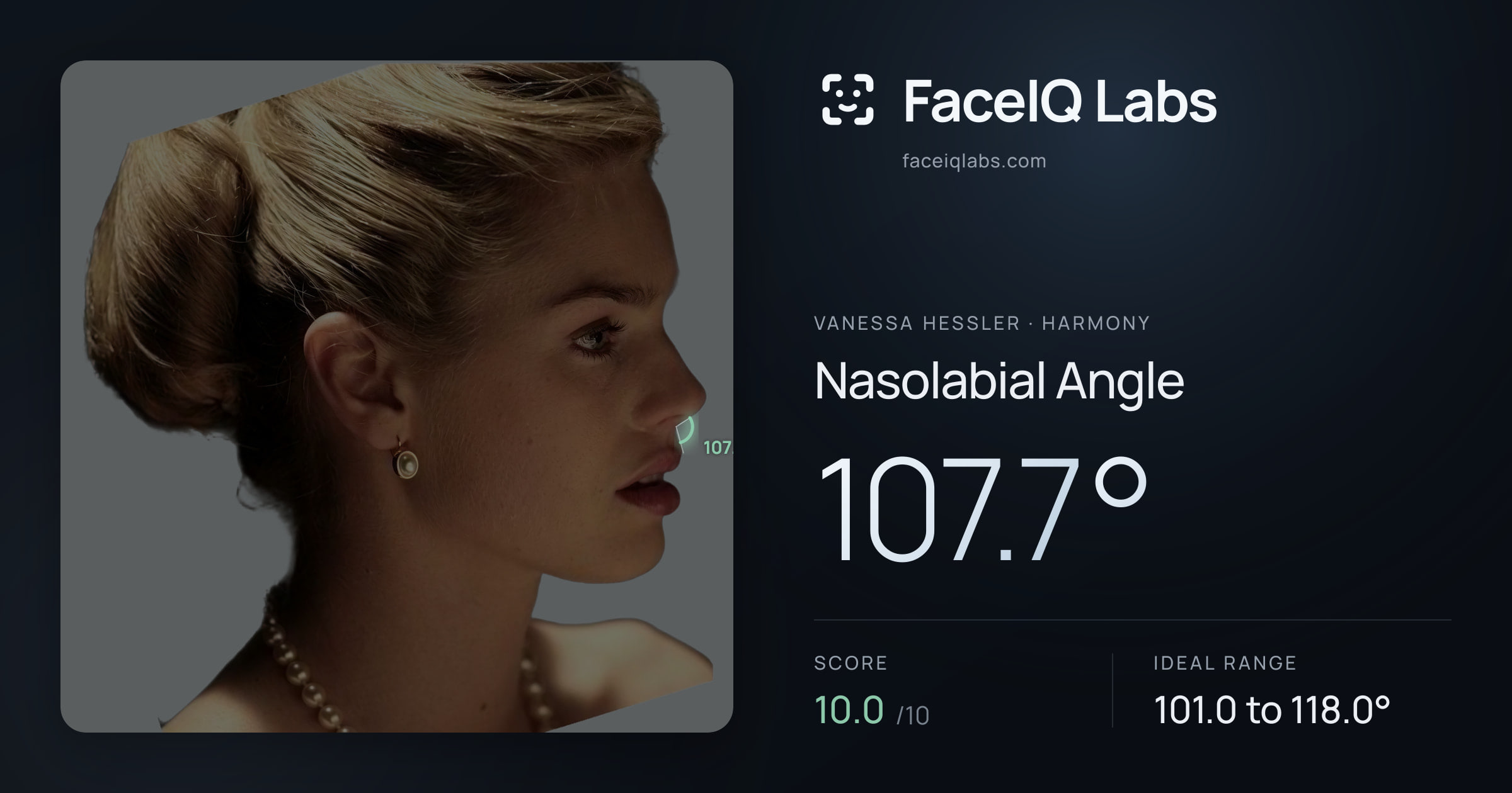 Vanessa Hessler Nasolabial Angle: 107.7°, drawn on the photo