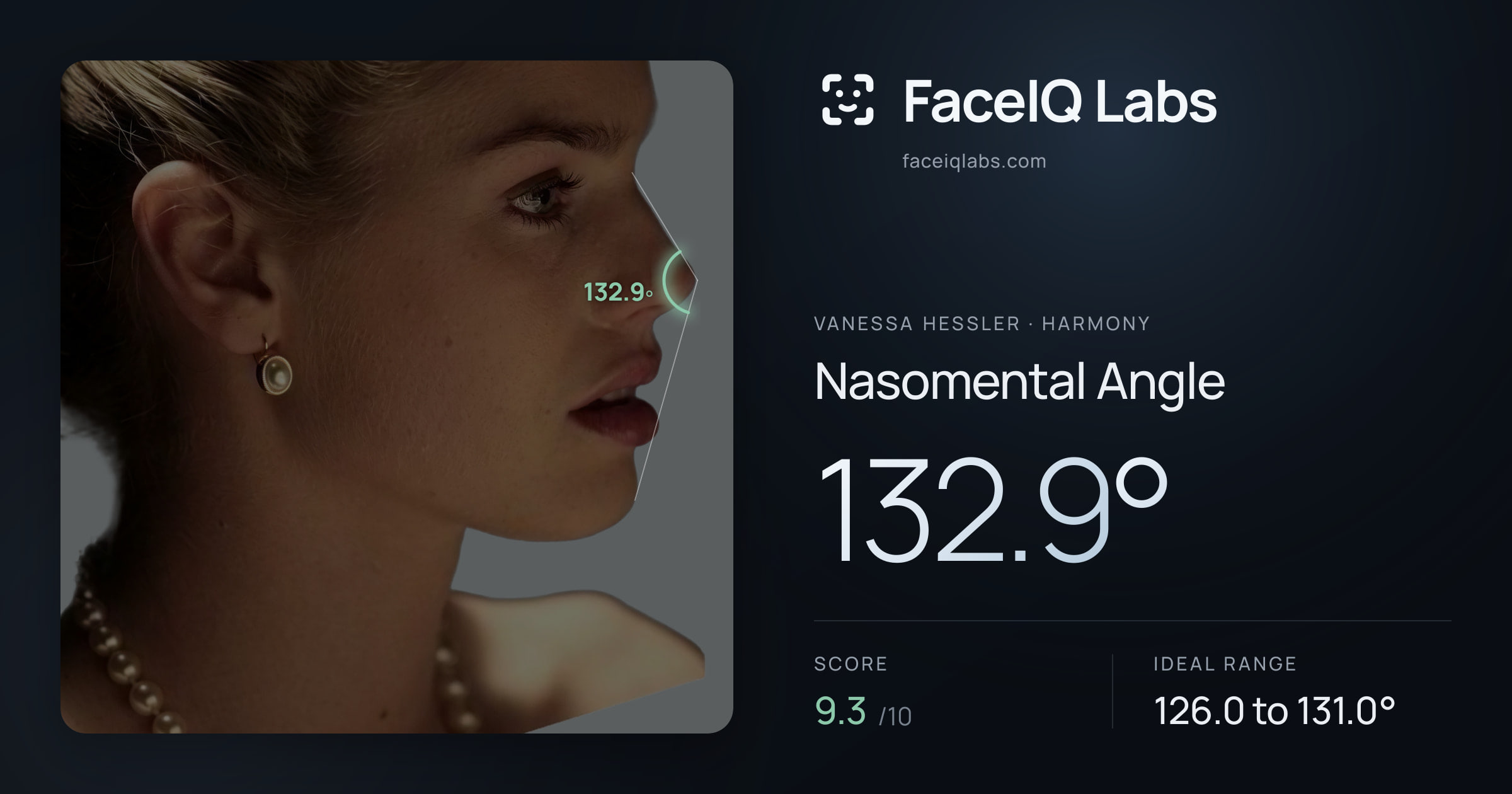 Vanessa Hessler Nasomental Angle: 132.9°, drawn on the photo