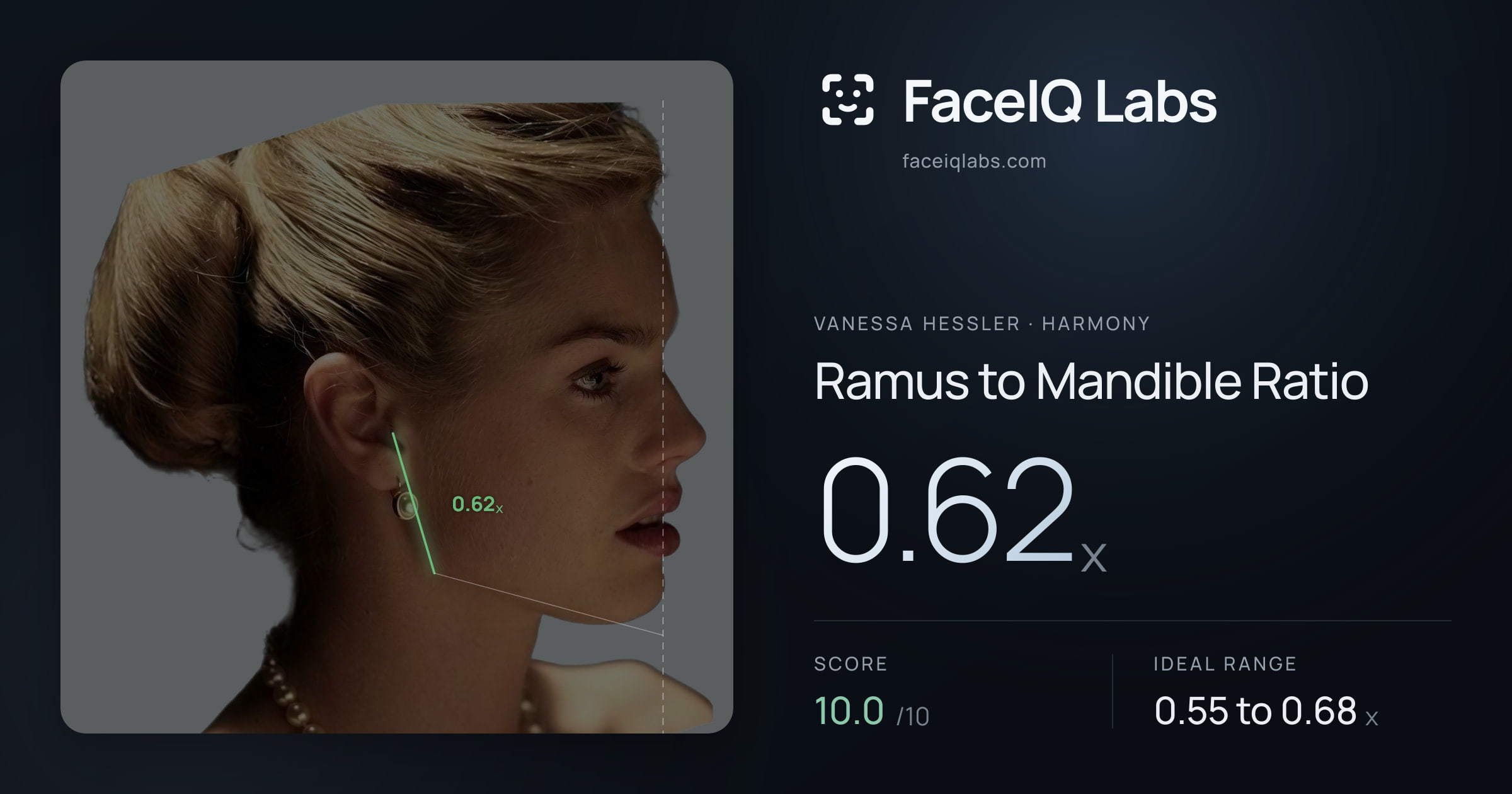 Vanessa Hessler Ramus to Mandible Ratio: 0.62x, drawn on the photo