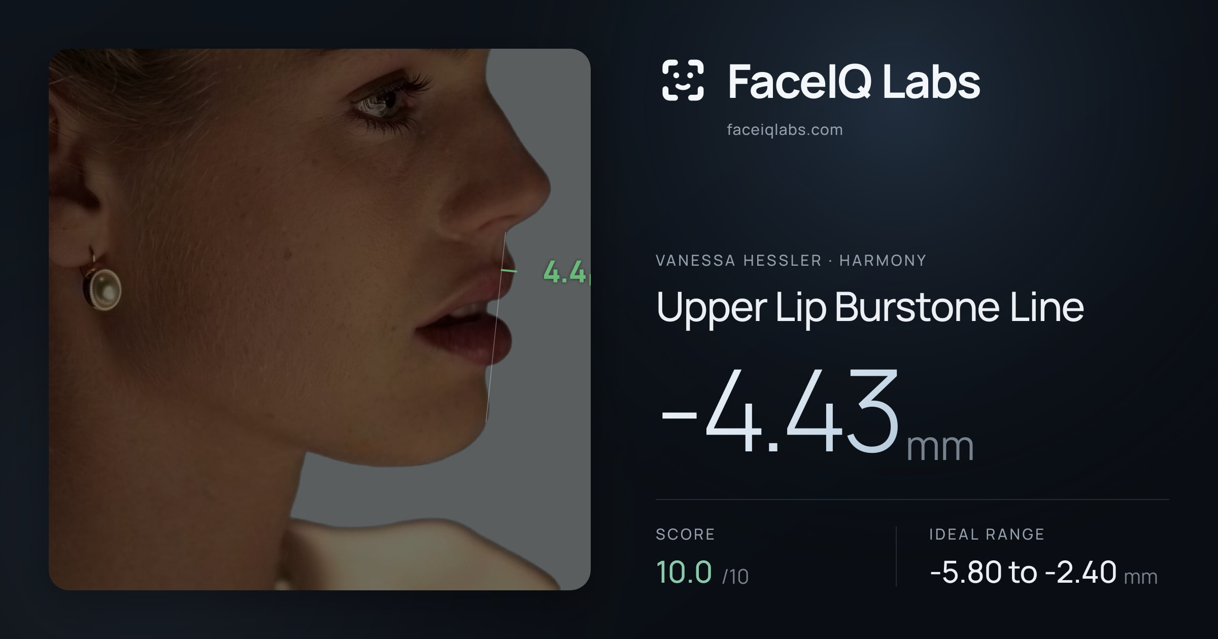 Vanessa Hessler Upper Lip Burstone Line: -4.43mm, drawn on the photo
