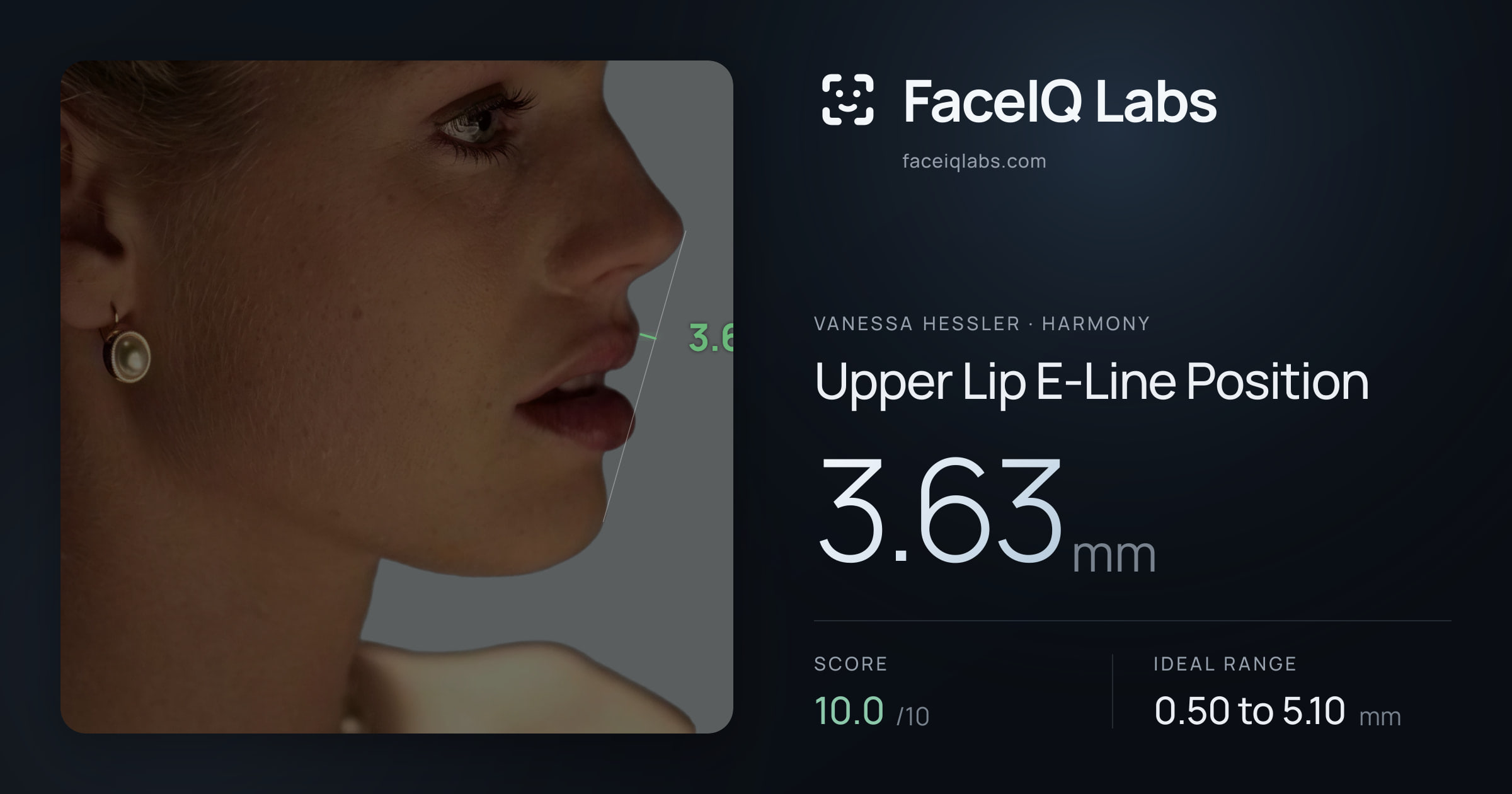 Vanessa Hessler Upper Lip E-Line Position: 3.63mm, drawn on the photo