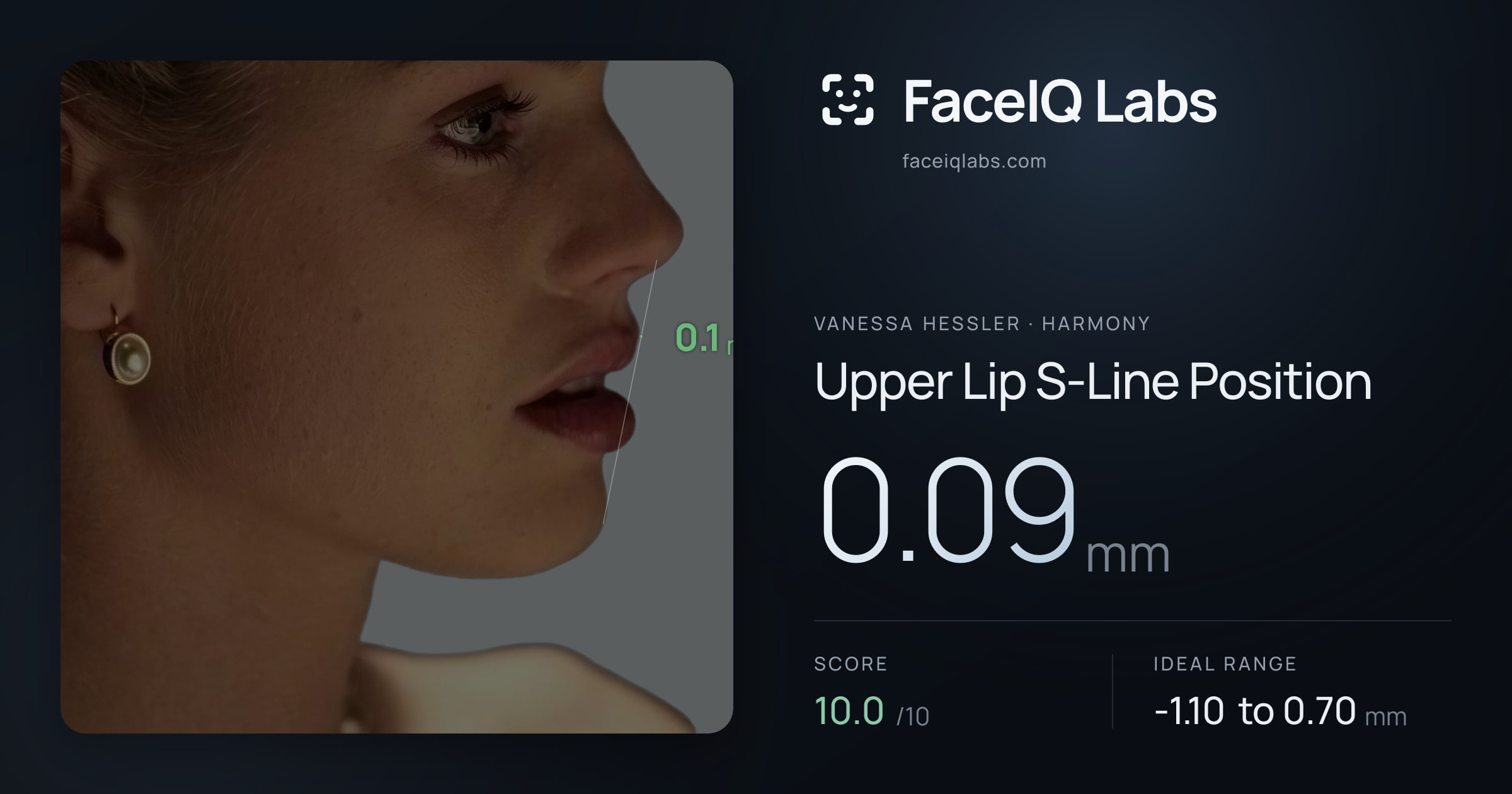 Vanessa Hessler Upper Lip S-Line Position: 0.09mm, drawn on the photo