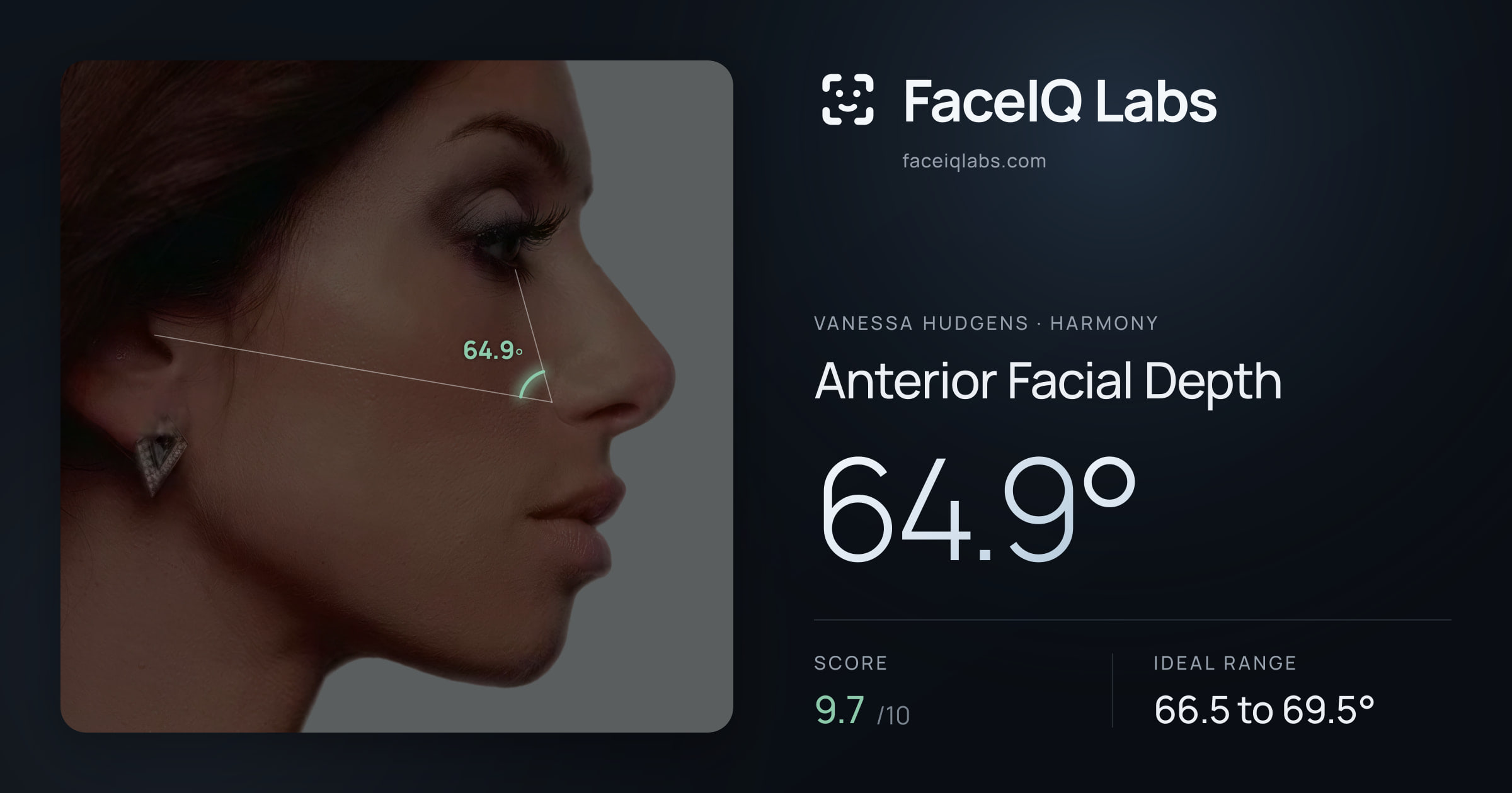 Vanessa Hudgens Anterior Facial Depth: 64.9°, drawn on the photo