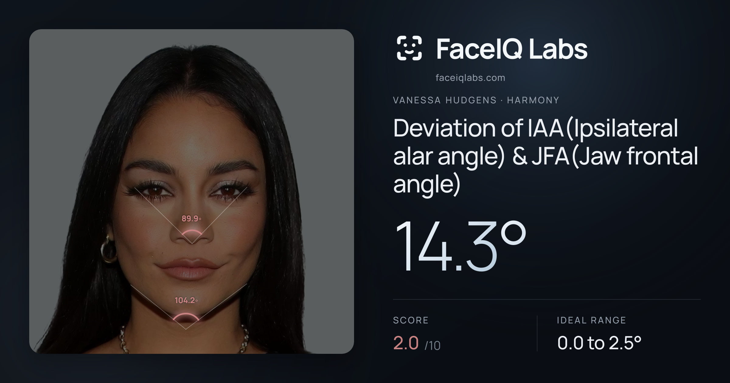 Vanessa Hudgens Deviation of IAA(Ipsilateral alar angle) & JFA(Jaw frontal angle): 14.3°, drawn on the photo