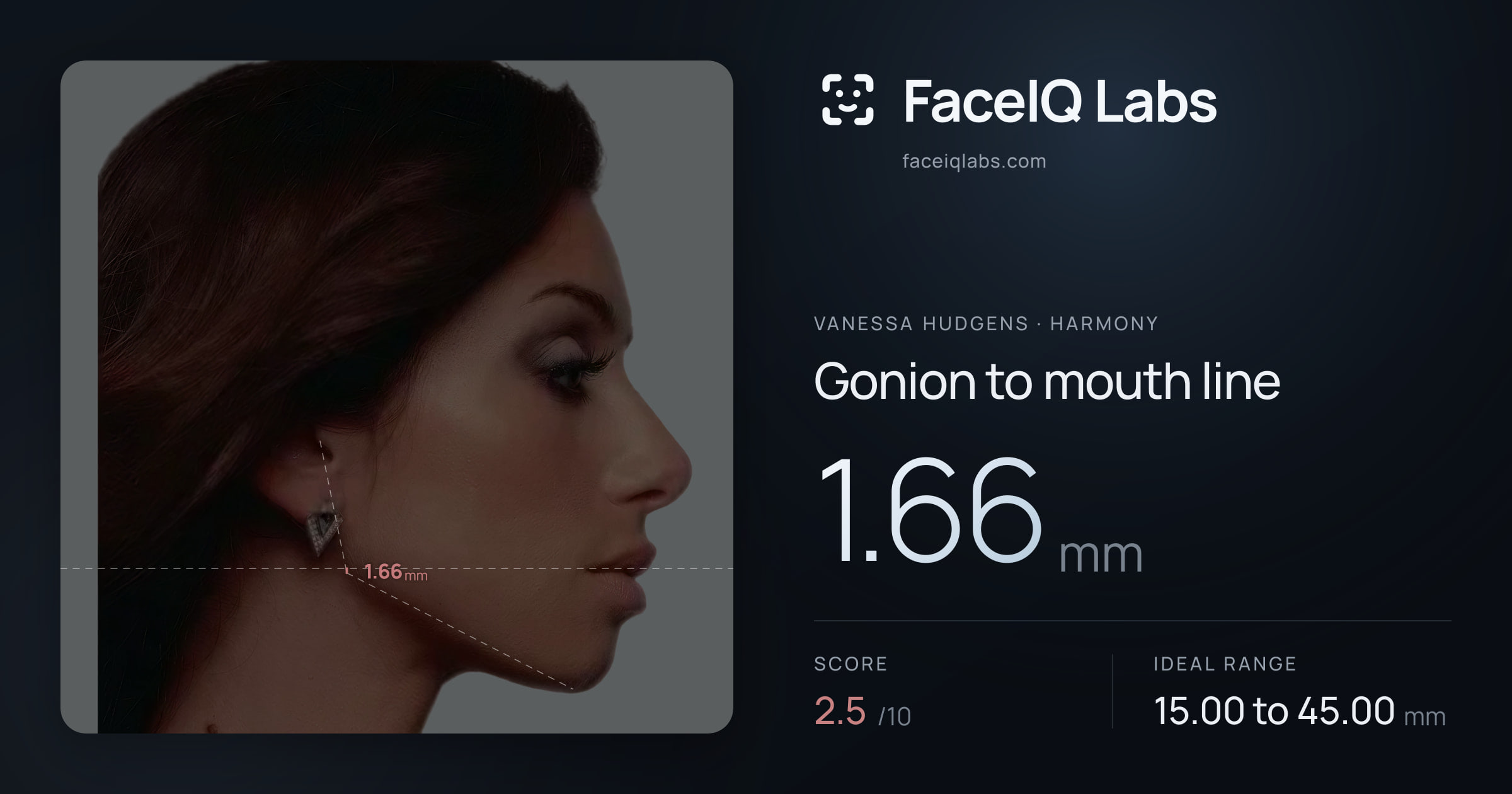 Vanessa Hudgens Gonion to mouth line: 1.66mm, drawn on the photo