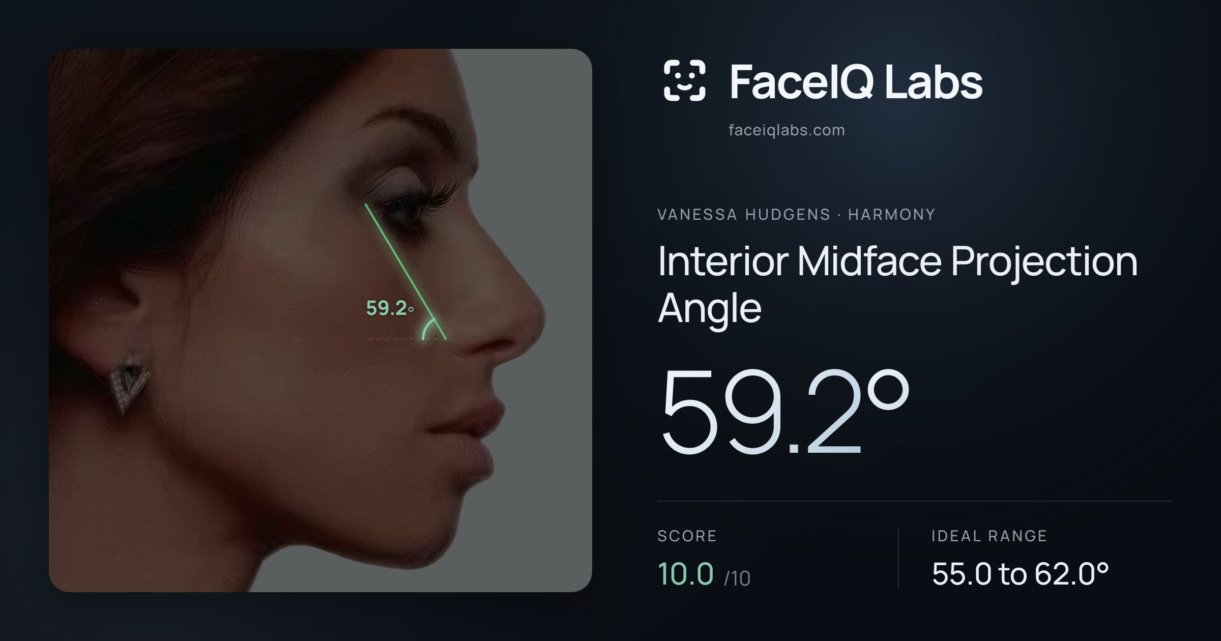 Vanessa Hudgens Interior Midface Projection Angle: 59.2°, drawn on the photo