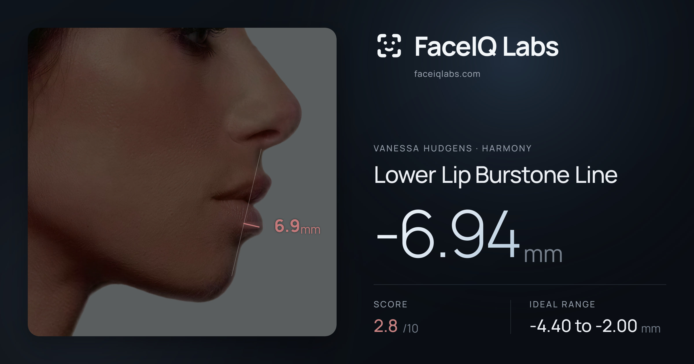 Vanessa Hudgens Lower Lip Burstone Line: -6.94mm, drawn on the photo