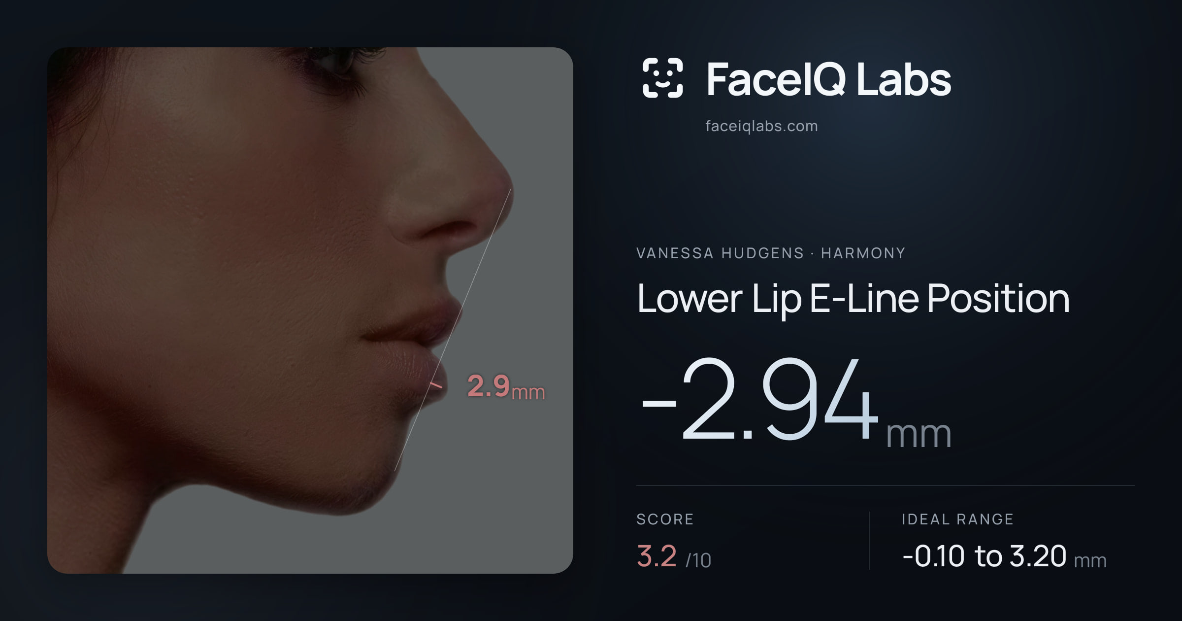 Vanessa Hudgens Lower Lip E-Line Position: -2.94mm, drawn on the photo
