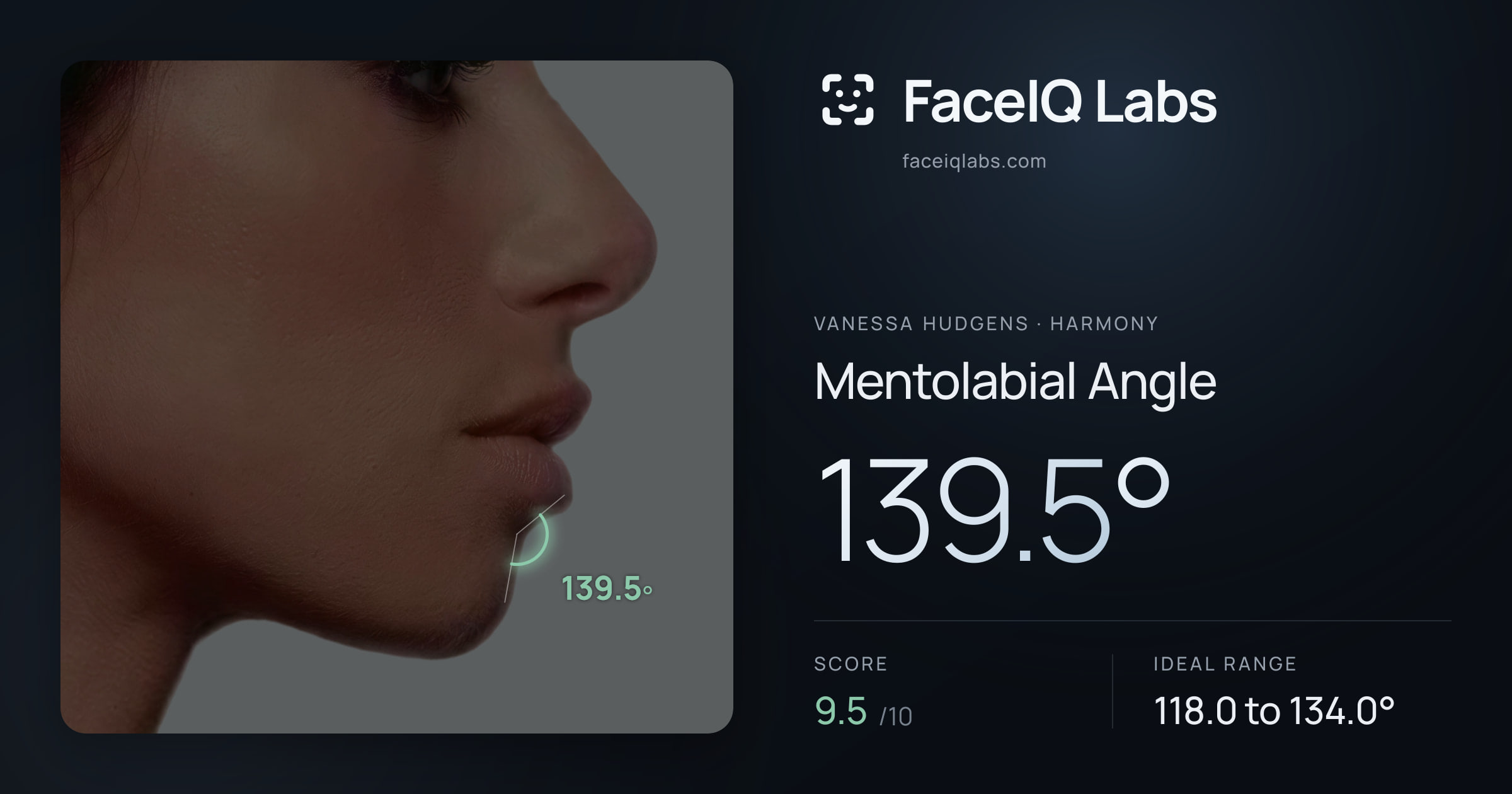 Vanessa Hudgens Mentolabial Angle: 139.5°, drawn on the photo