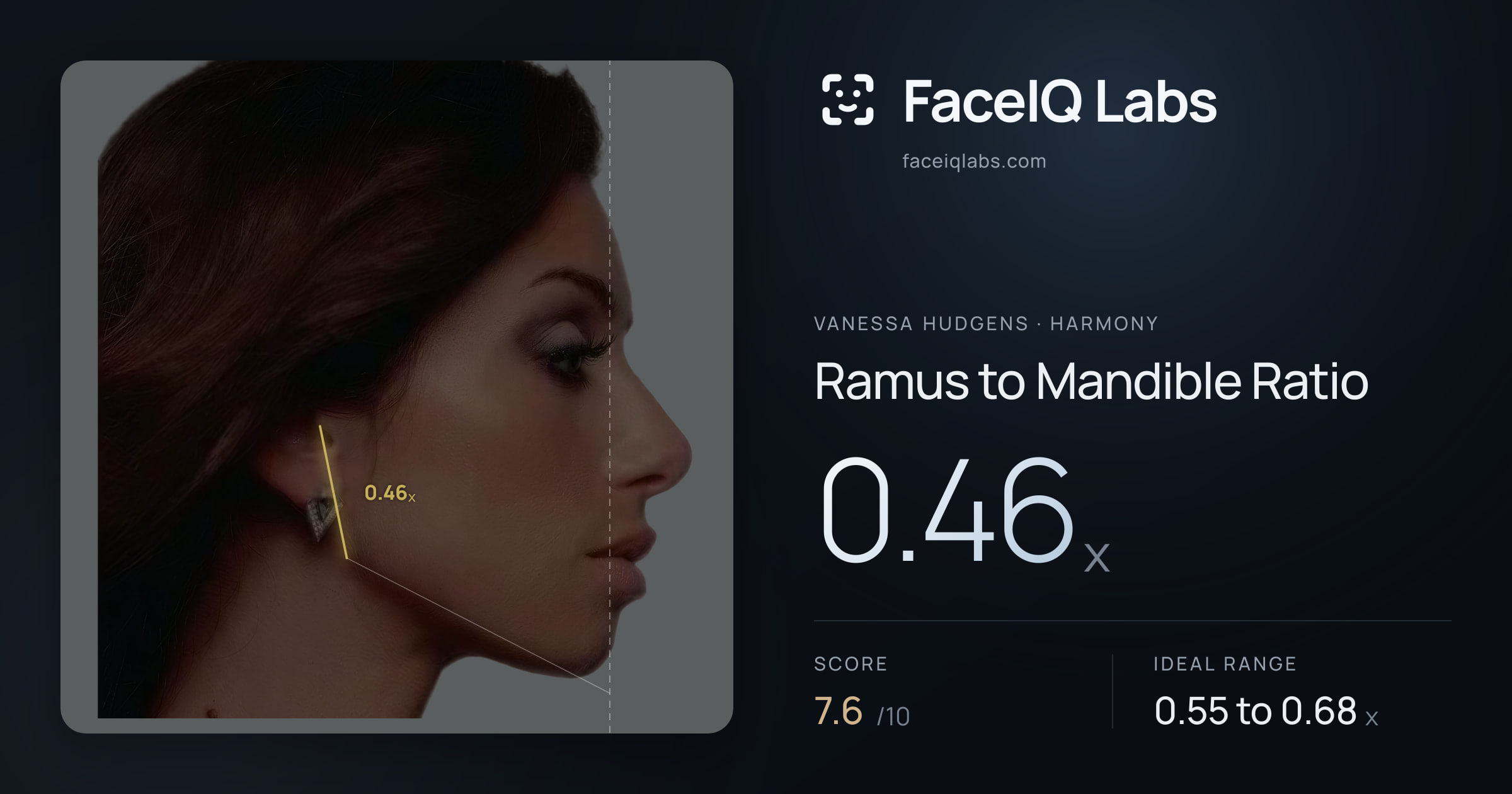 Vanessa Hudgens Ramus to Mandible Ratio: 0.46x, drawn on the photo