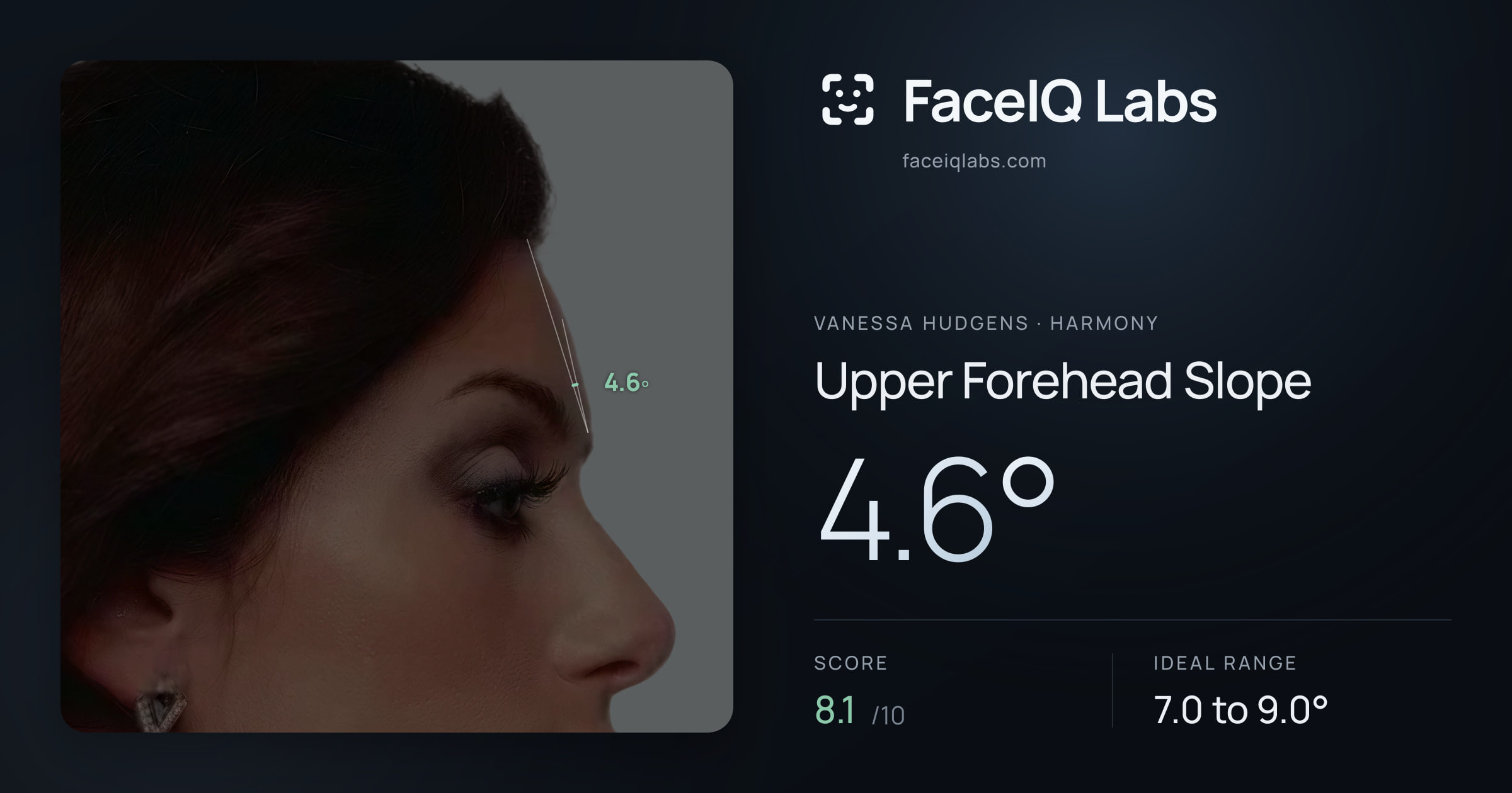 Vanessa Hudgens Upper Forehead Slope: 4.6°, drawn on the photo