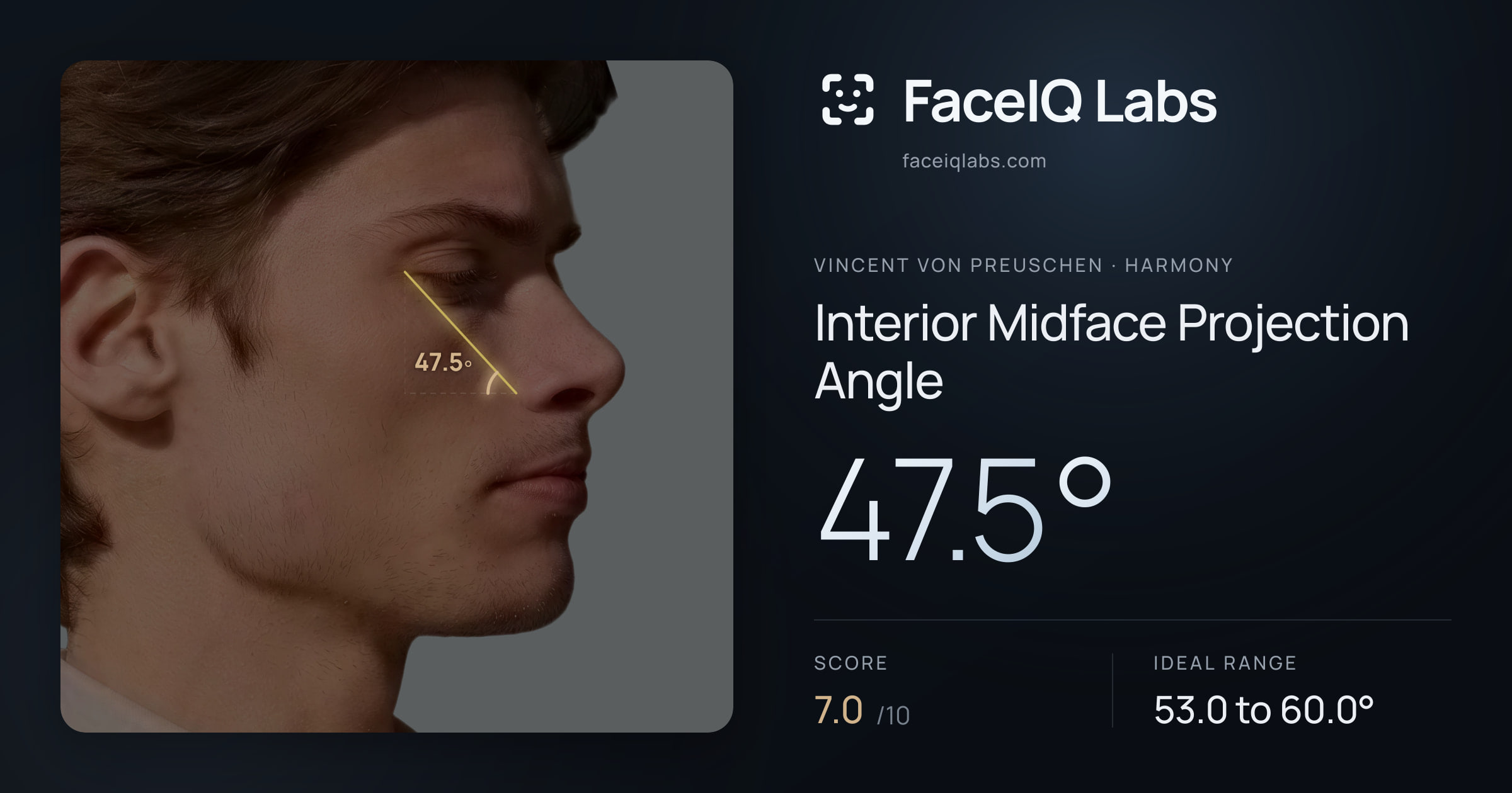 Vincent von Preuschen Interior Midface Projection Angle: 47.5°, drawn on the photo