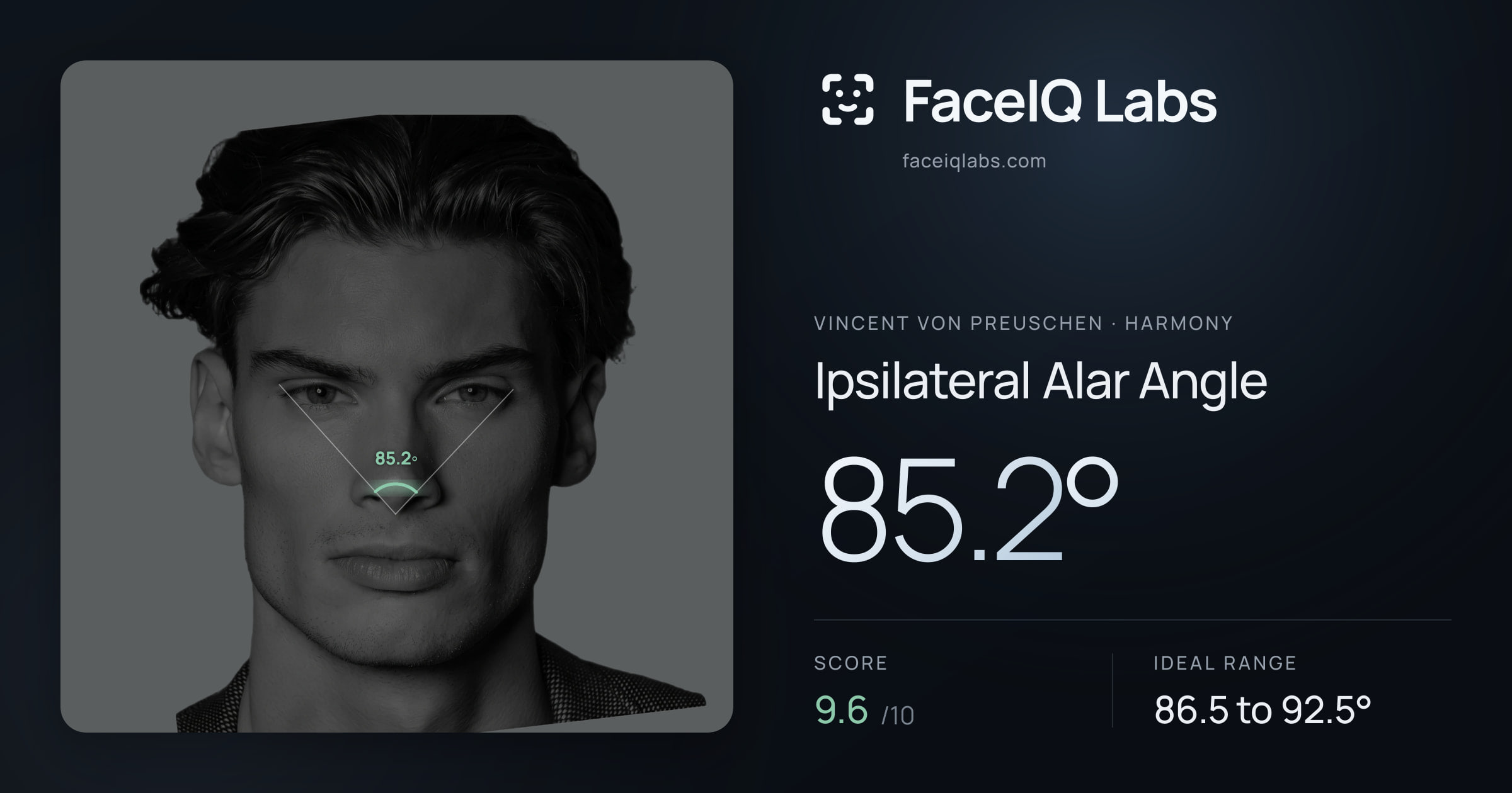 Vincent von Preuschen Ipsilateral Alar Angle: 85.2°, drawn on the photo