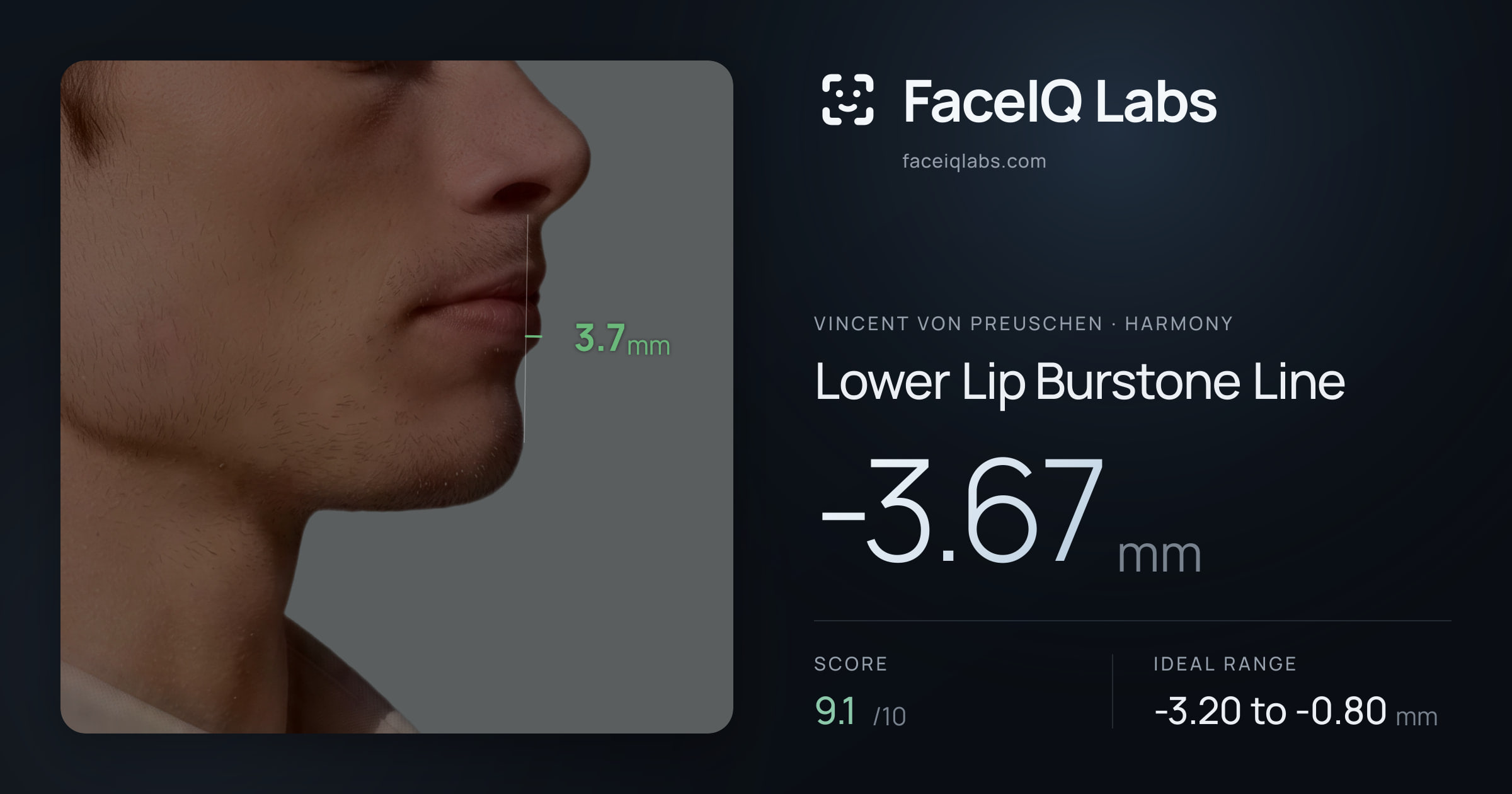 Vincent von Preuschen Lower Lip Burstone Line: -3.67mm, drawn on the photo