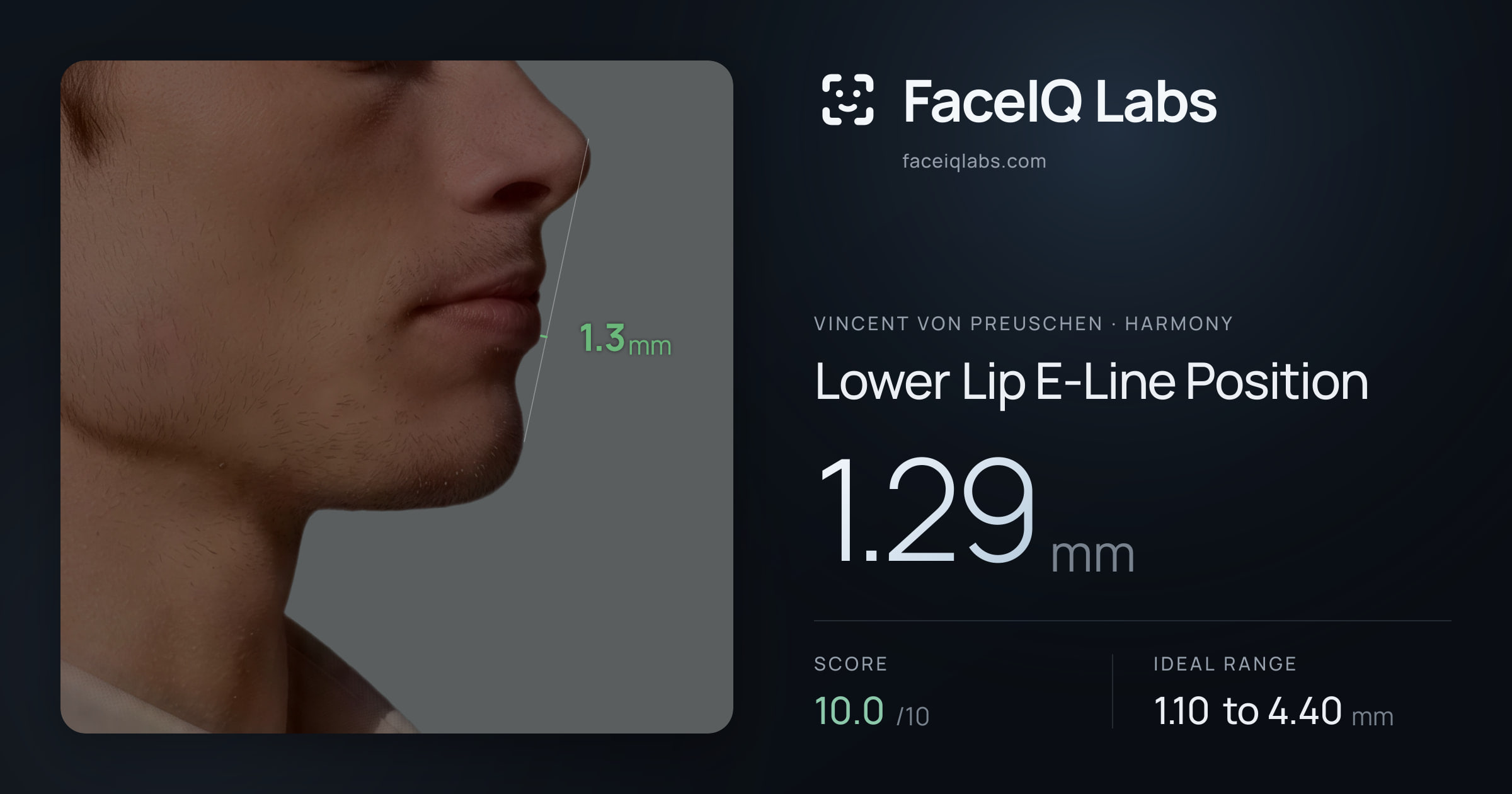 Vincent von Preuschen Lower Lip E-Line Position: 1.29mm, drawn on the photo