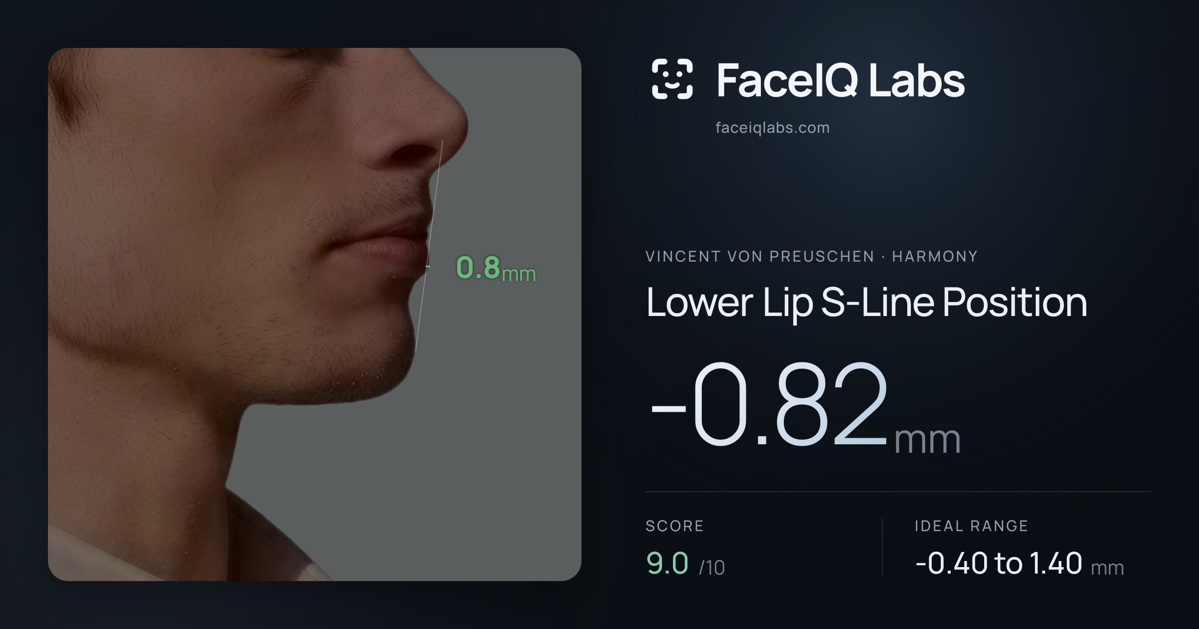 Vincent von Preuschen Lower Lip S-Line Position: -0.82mm, drawn on the photo