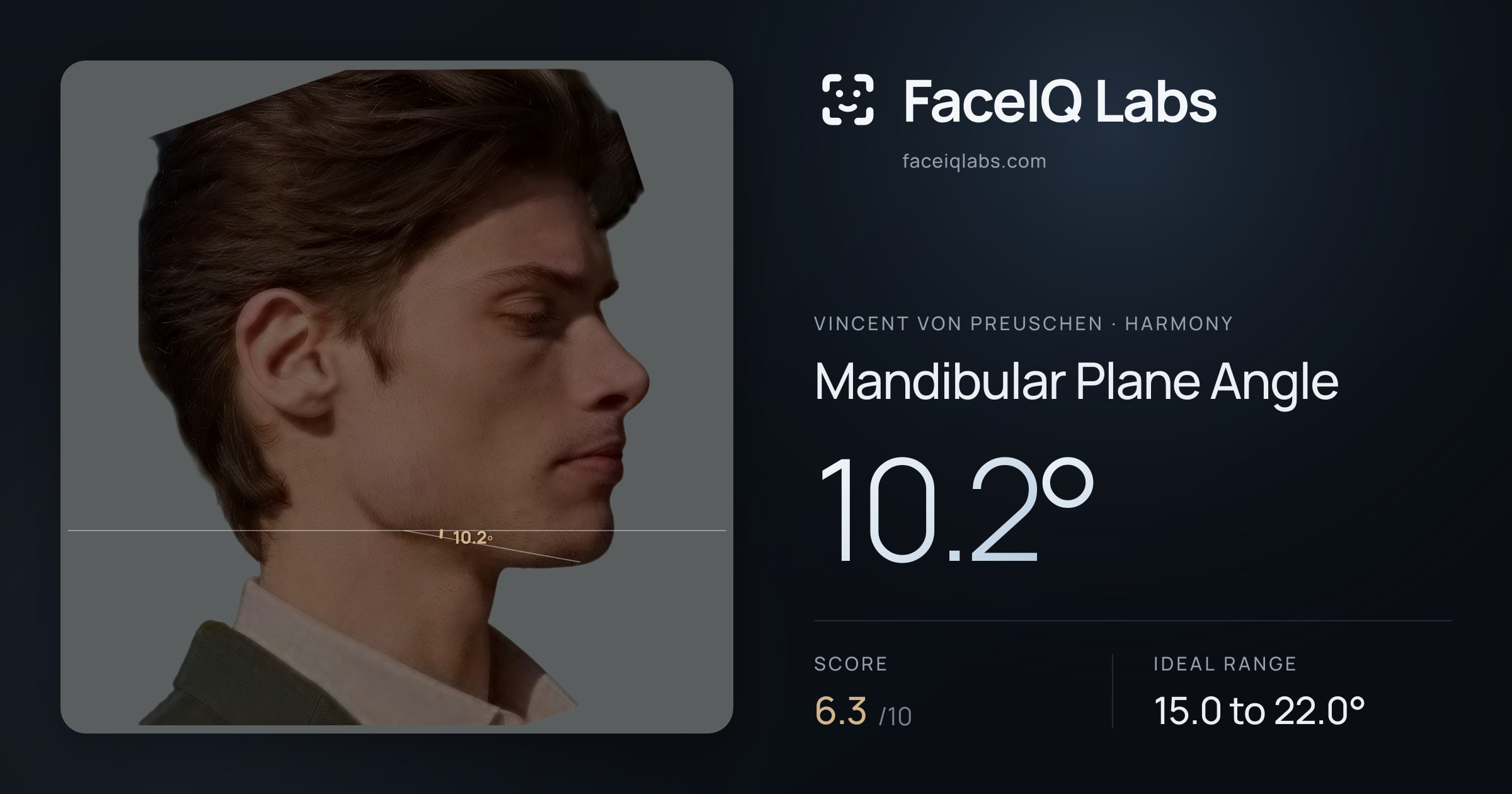 Vincent von Preuschen Mandibular Plane Angle: 10.2°, drawn on the photo