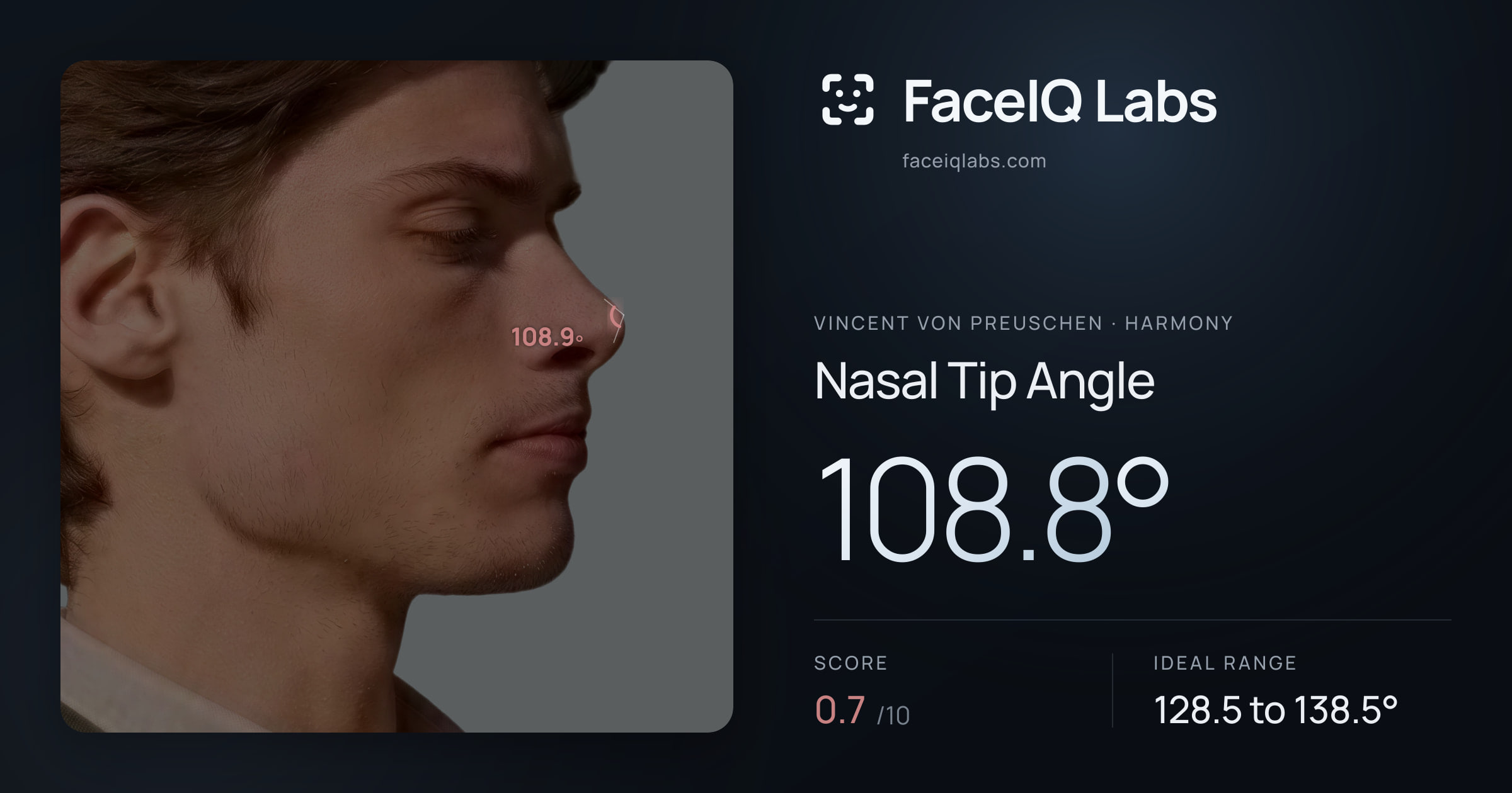 Vincent von Preuschen Nasal Tip Angle: 108.8°, drawn on the photo