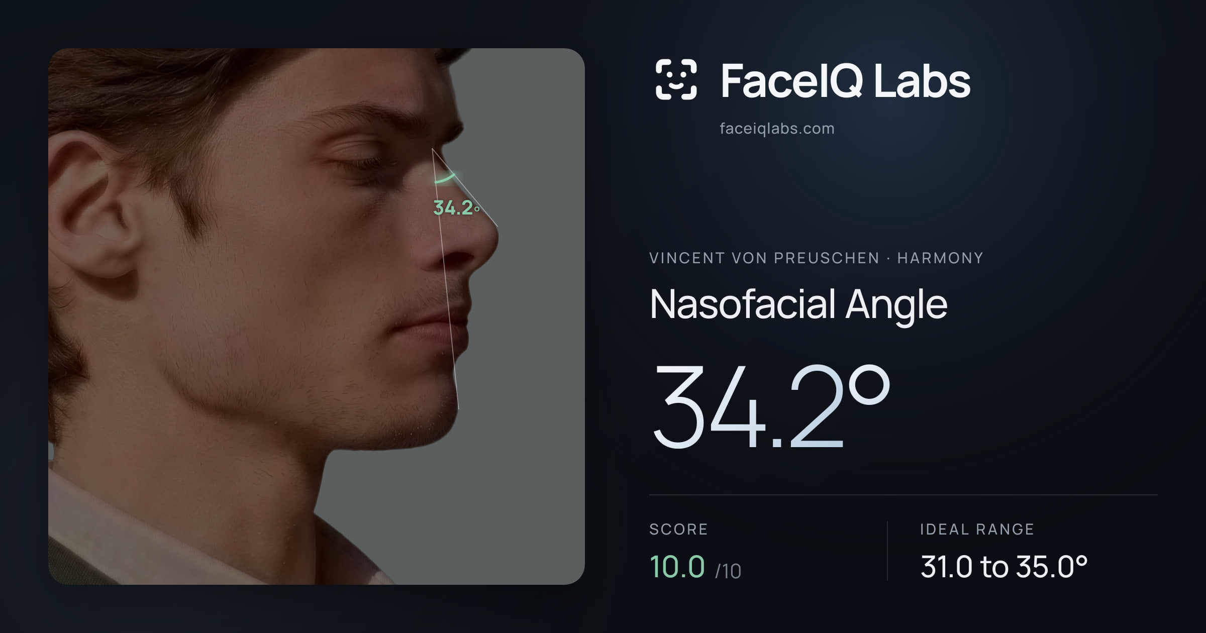 Vincent von Preuschen Nasofacial Angle: 34.2°, drawn on the photo