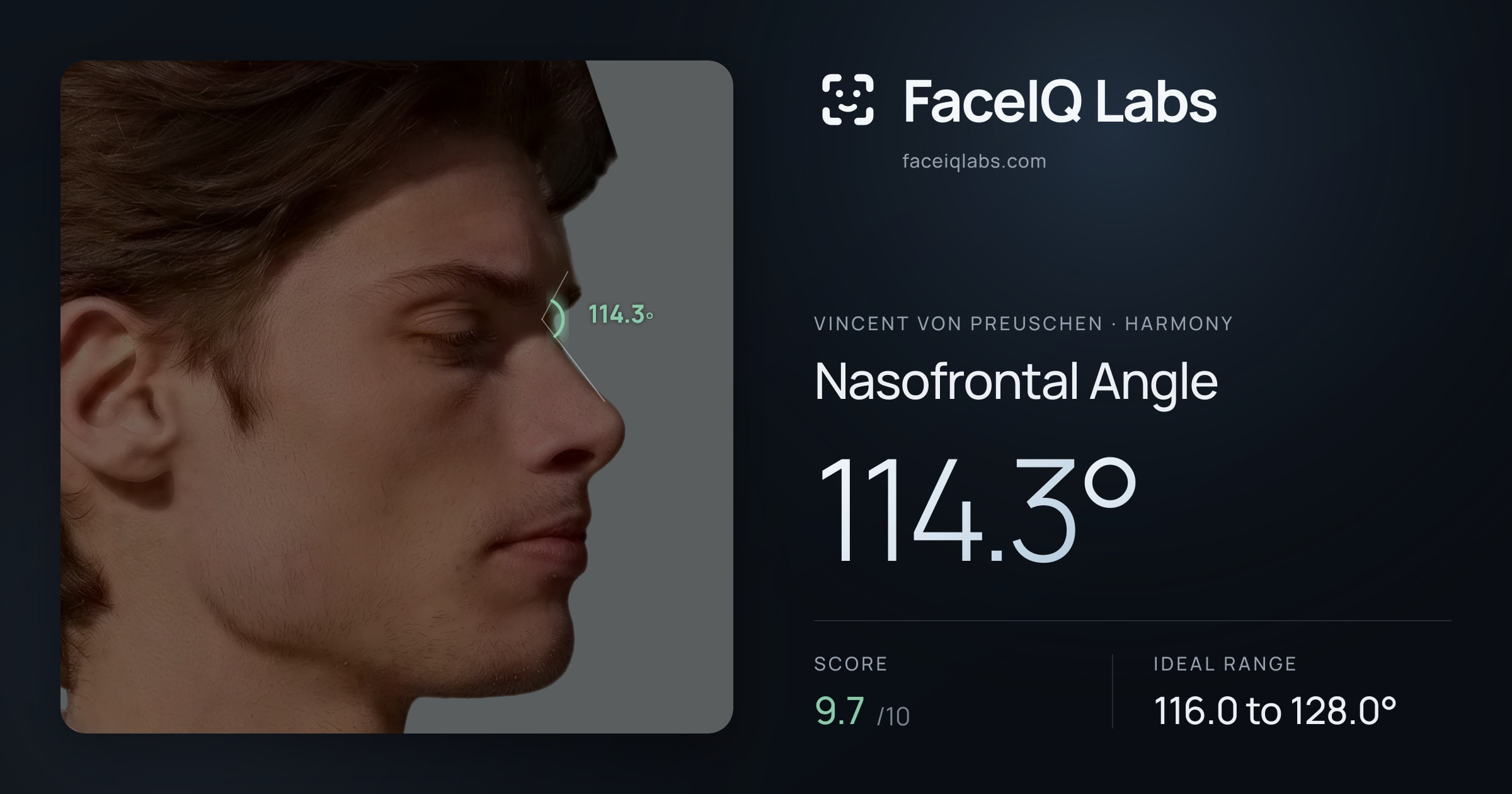 Vincent von Preuschen Nasofrontal Angle: 114.3°, drawn on the photo