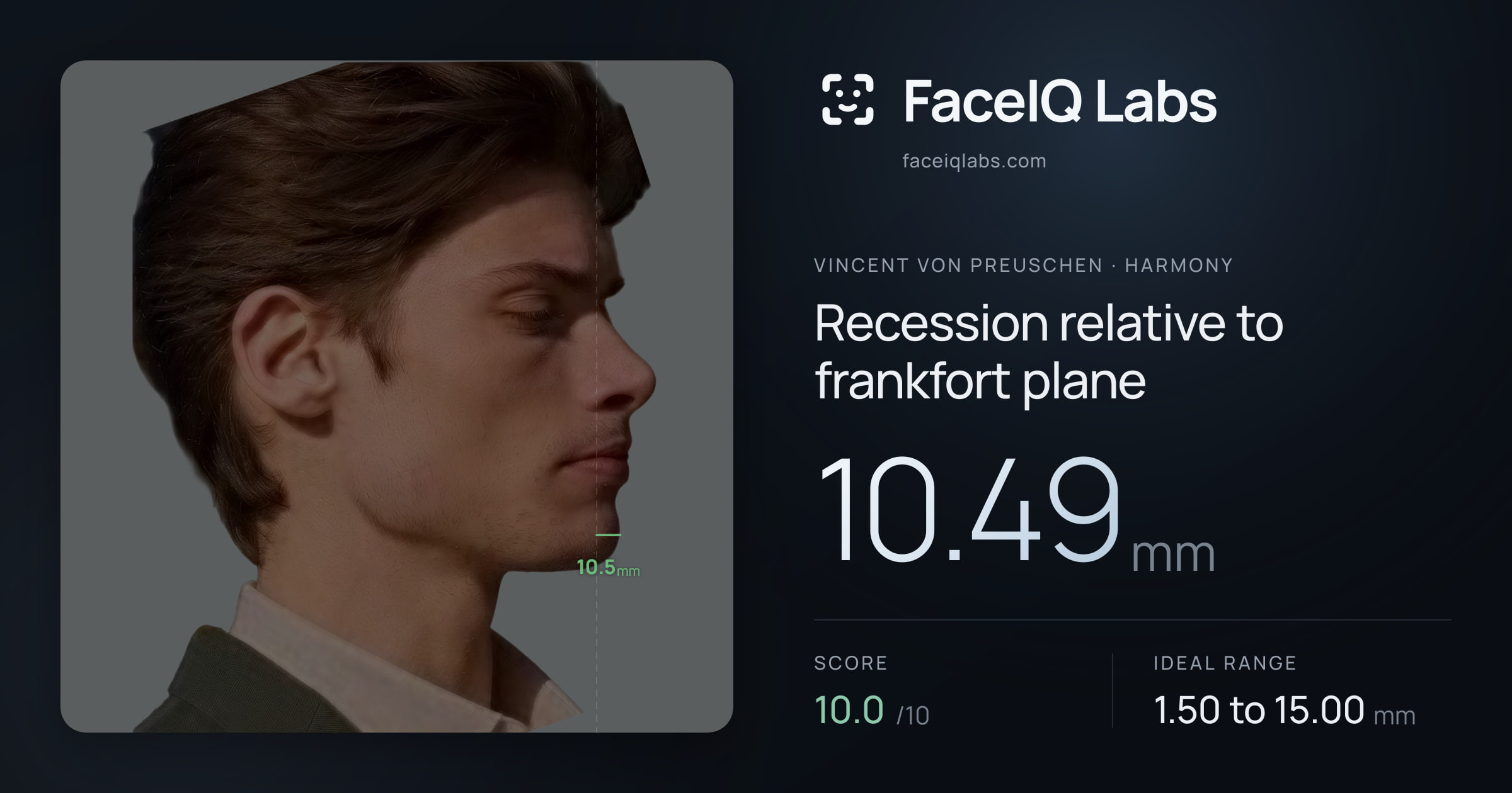 Vincent von Preuschen Recession relative to frankfort plane: 10.49mm, drawn on the photo