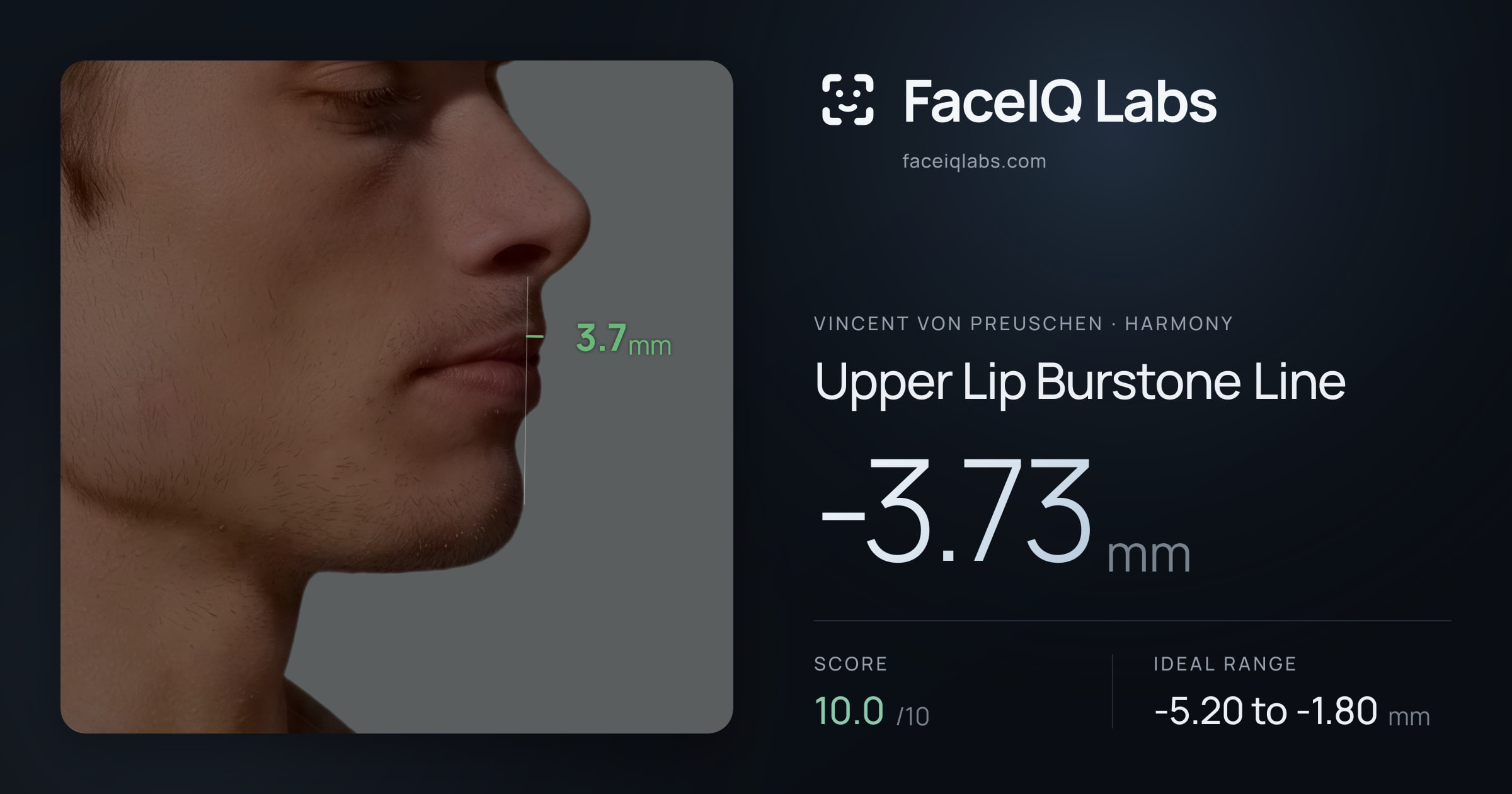Vincent von Preuschen Upper Lip Burstone Line: -3.73mm, drawn on the photo