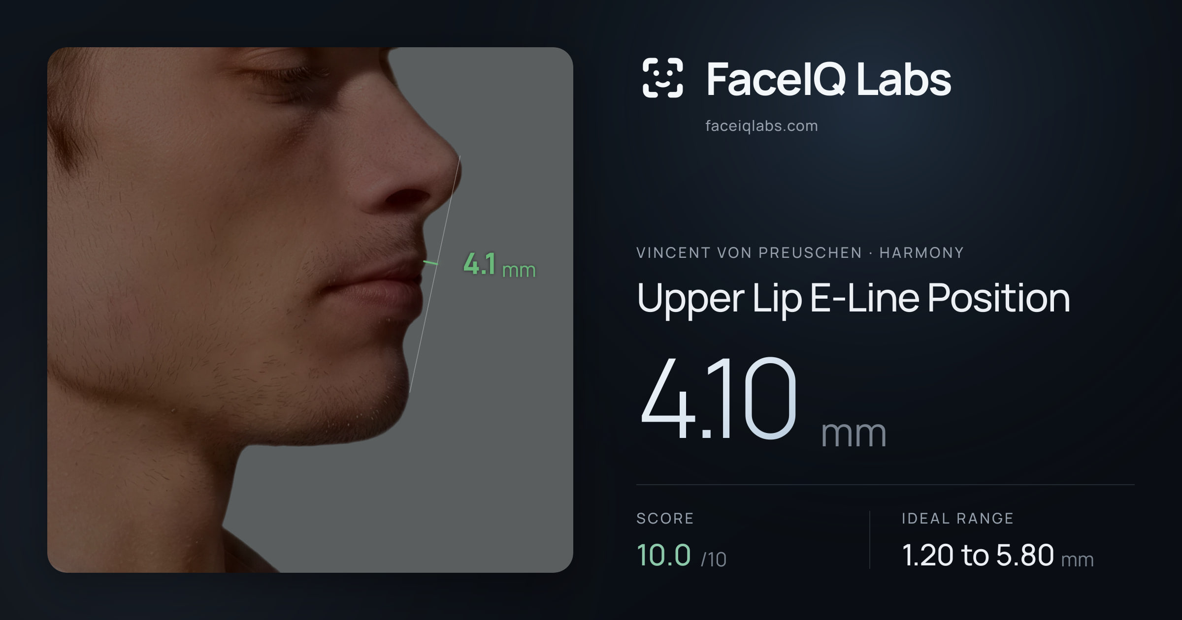 Vincent von Preuschen Upper Lip E-Line Position: 4.10mm, drawn on the photo