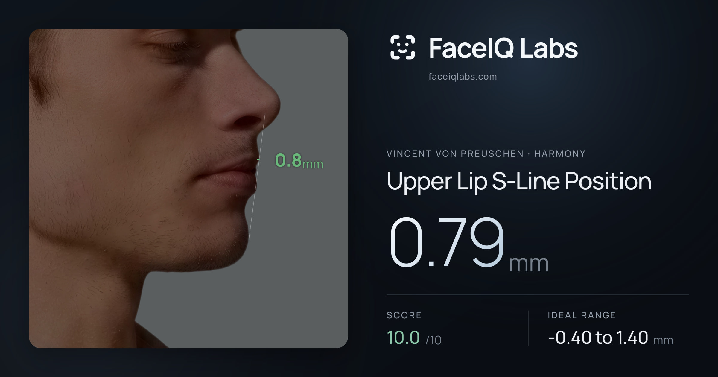 Vincent von Preuschen Upper Lip S-Line Position: 0.79mm, drawn on the photo