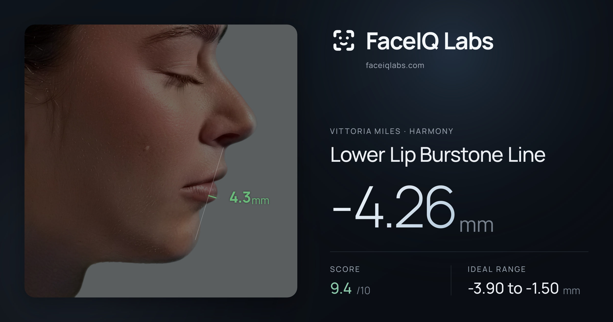 Vittoria Miles Lower Lip Burstone Line: -4.26mm, drawn on the photo