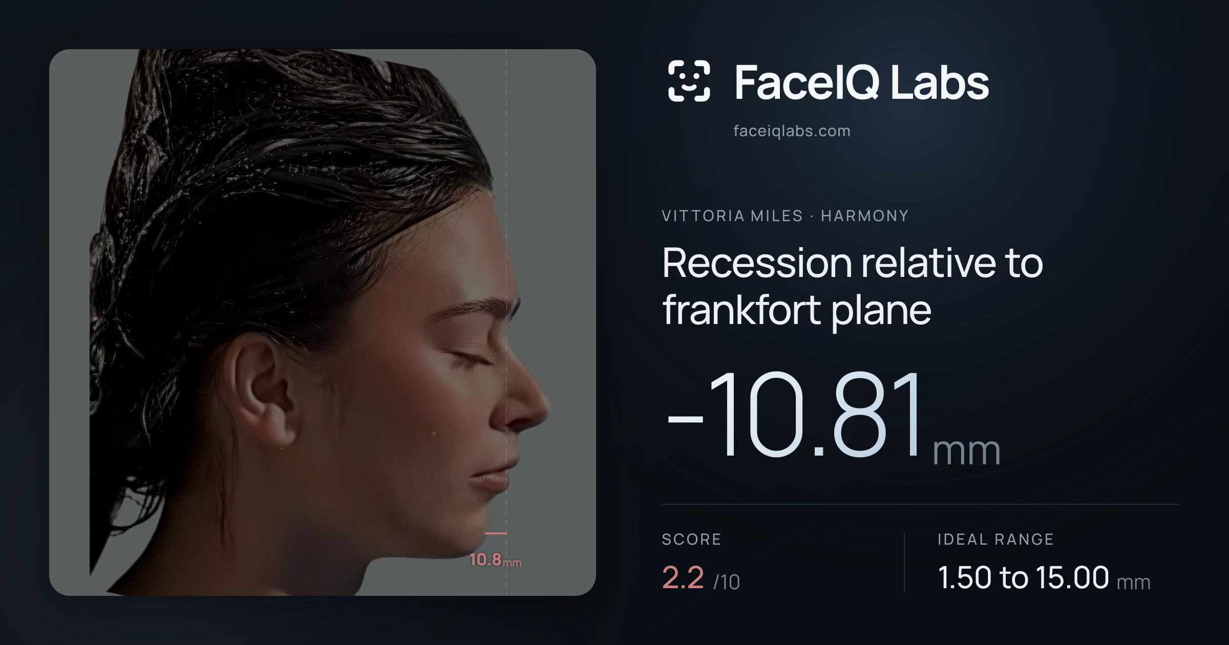 Vittoria Miles Recession relative to frankfort plane: -10.81mm, drawn on the photo