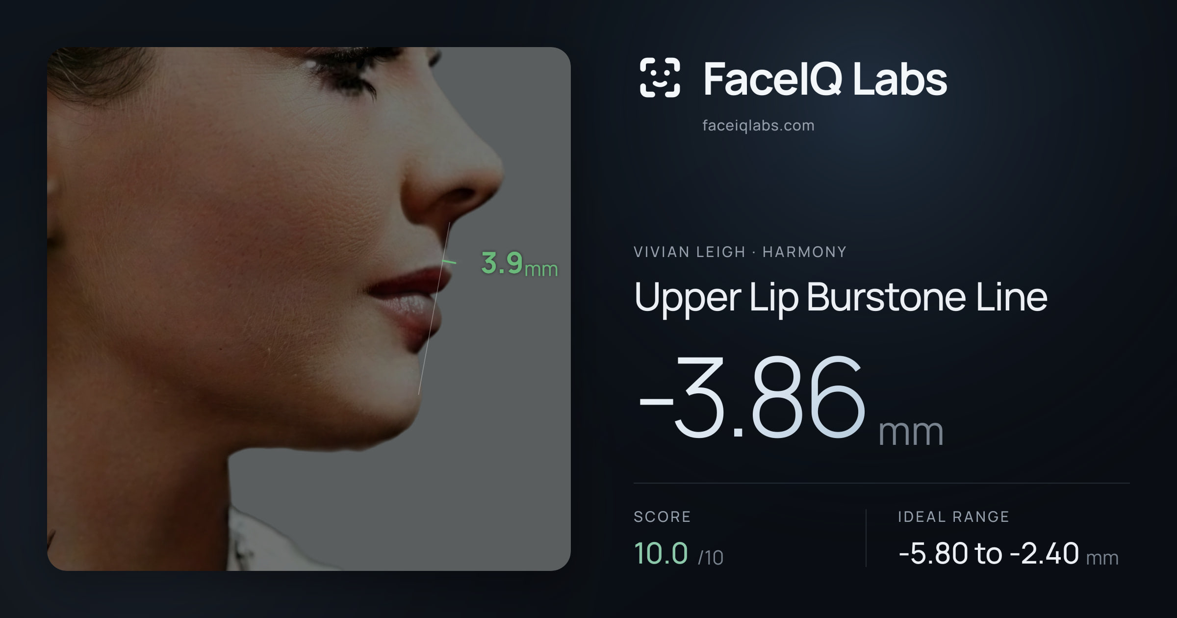 Vivian Leigh Upper Lip Burstone Line: -3.86mm, drawn on the photo
