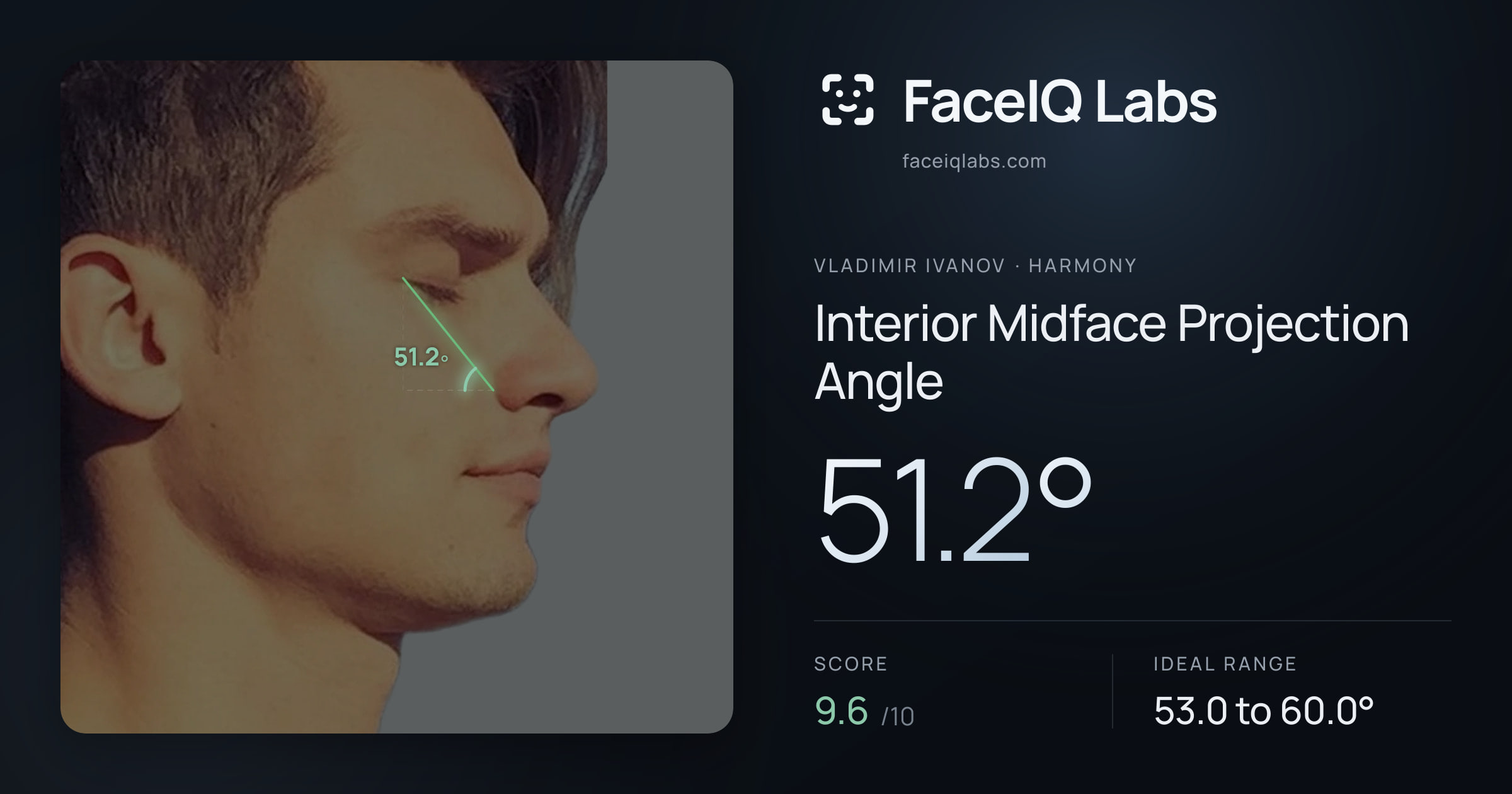 Vladimir Ivanov Interior Midface Projection Angle: 51.2°, drawn on the photo