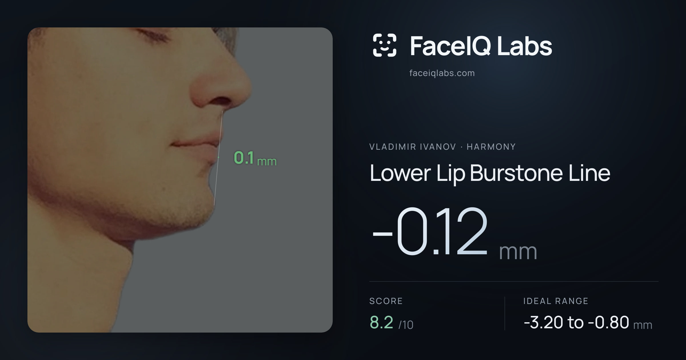 Vladimir Ivanov Lower Lip Burstone Line: -0.12mm, drawn on the photo