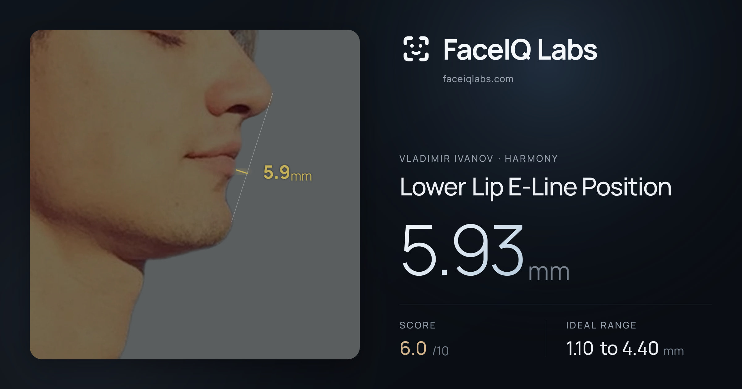 Vladimir Ivanov Lower Lip E-Line Position: 5.93mm, drawn on the photo