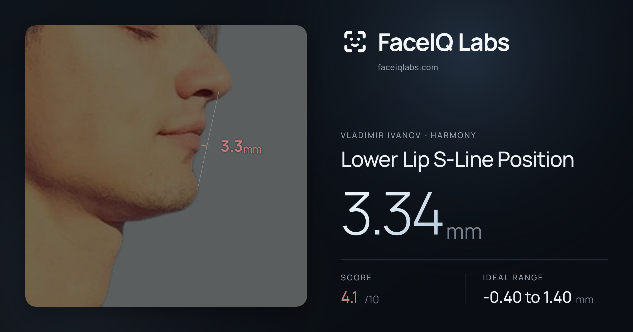 Vladimir Ivanov Lower Lip S-Line Position: 3.34mm, drawn on the photo