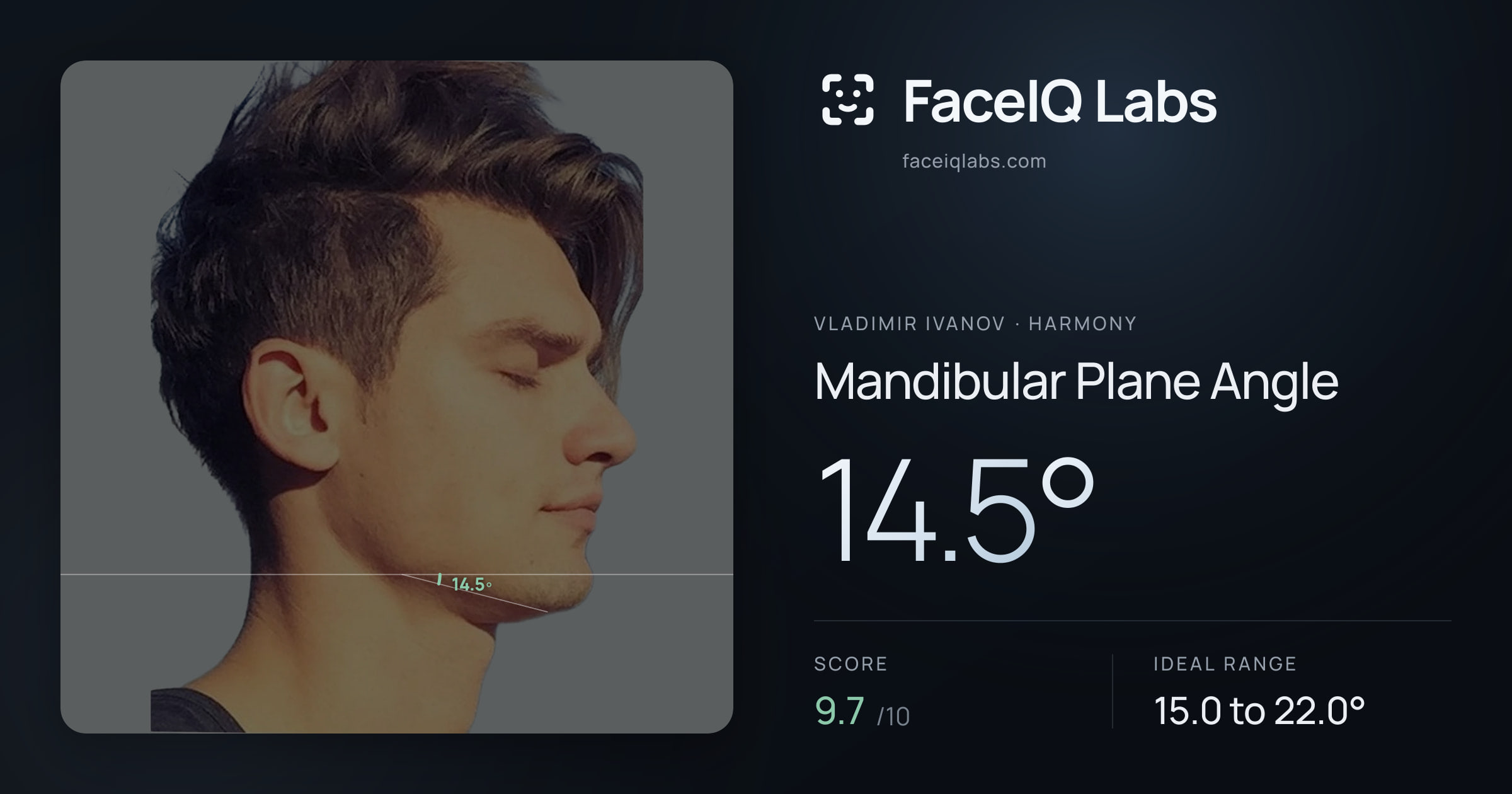 Vladimir Ivanov Mandibular Plane Angle: 14.5°, drawn on the photo
