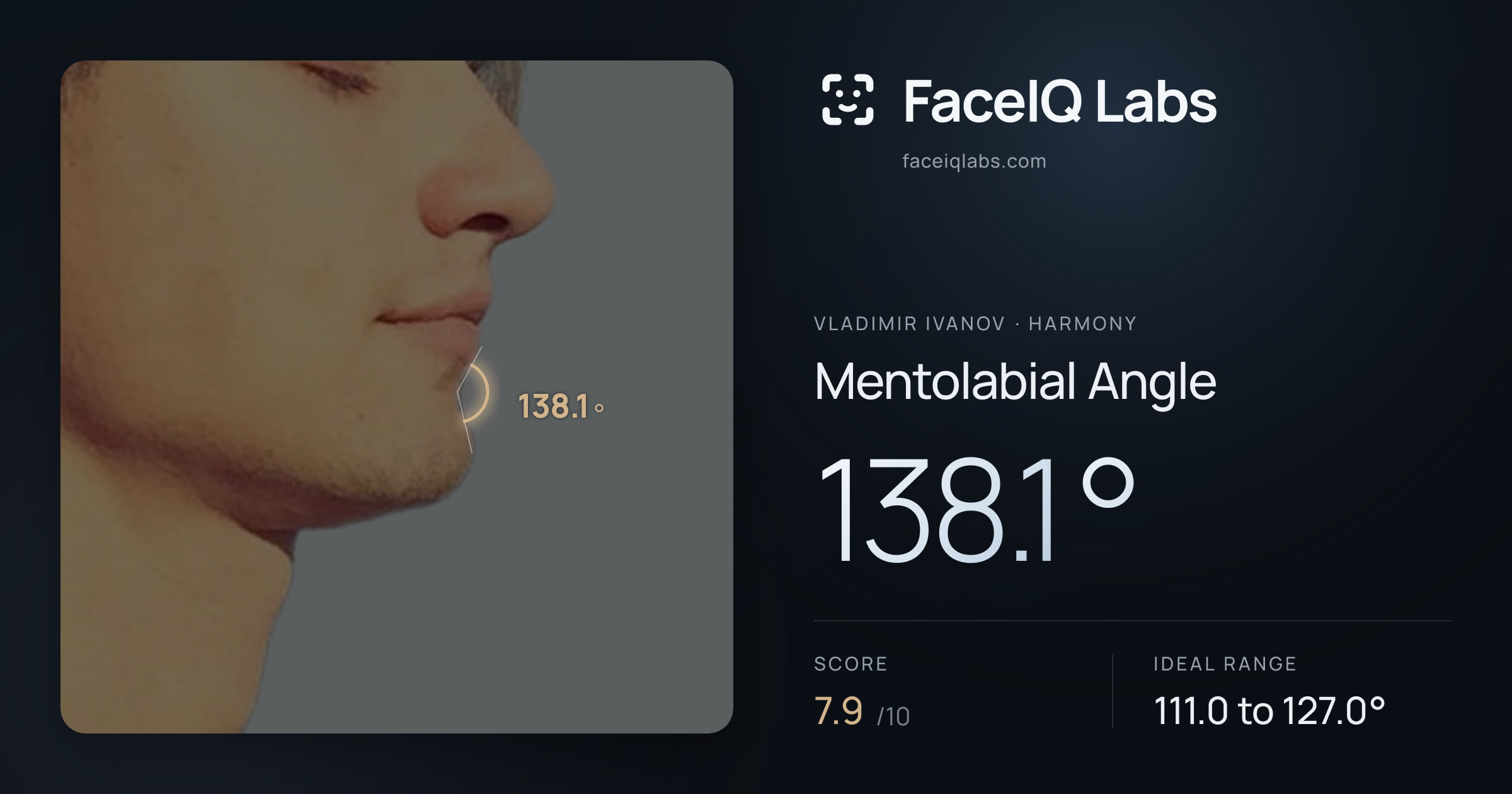 Vladimir Ivanov Mentolabial Angle: 138.1°, drawn on the photo