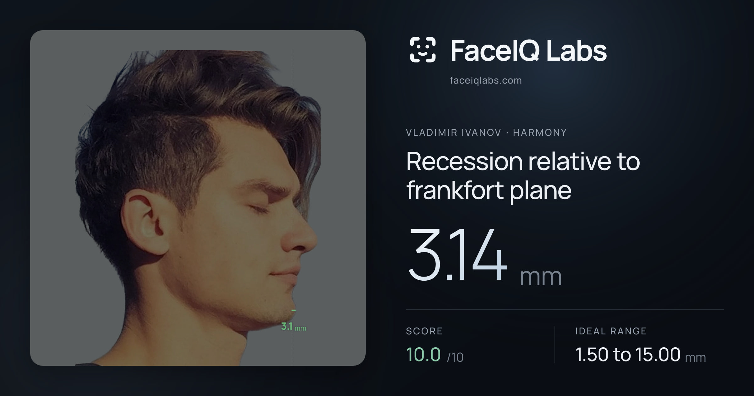 Vladimir Ivanov Recession relative to frankfort plane: 3.14mm, drawn on the photo