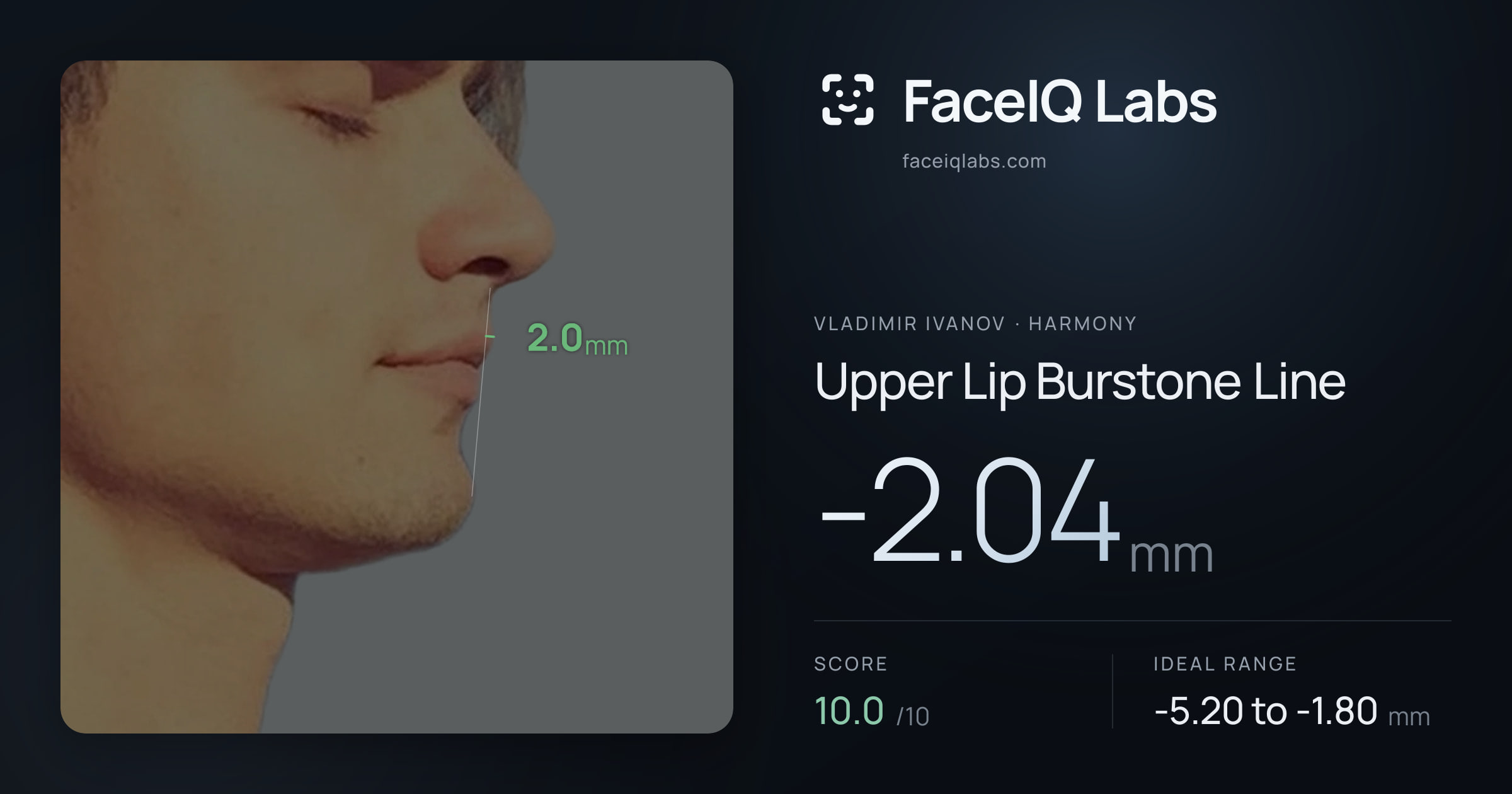 Vladimir Ivanov Upper Lip Burstone Line: -2.04mm, drawn on the photo
