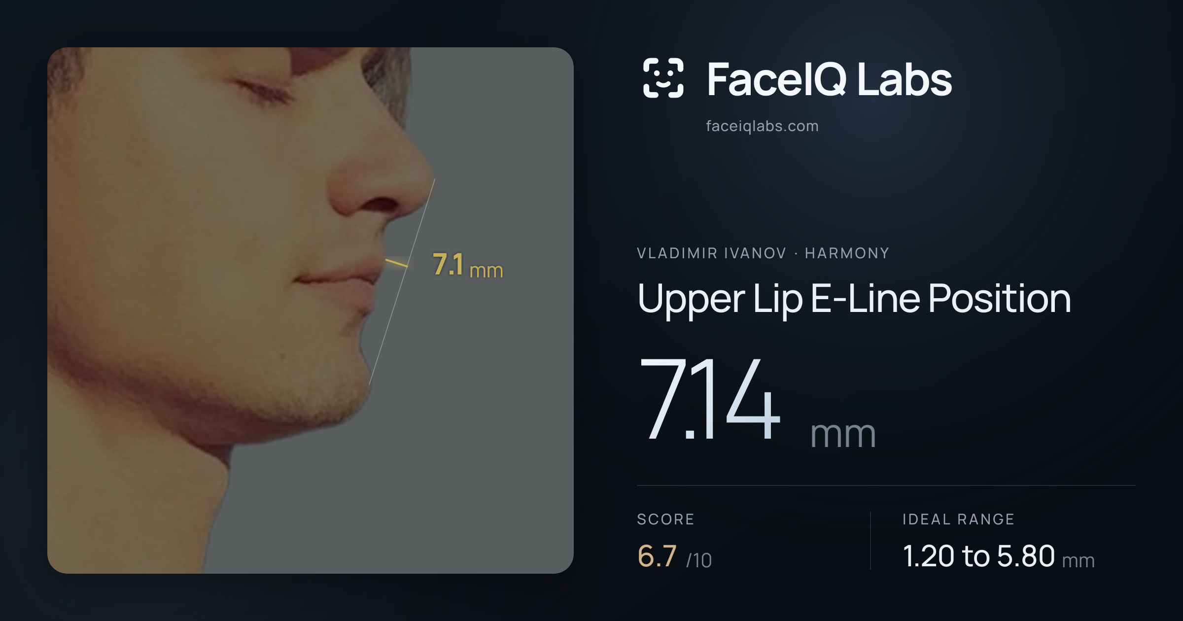 Vladimir Ivanov Upper Lip E-Line Position: 7.14mm, drawn on the photo