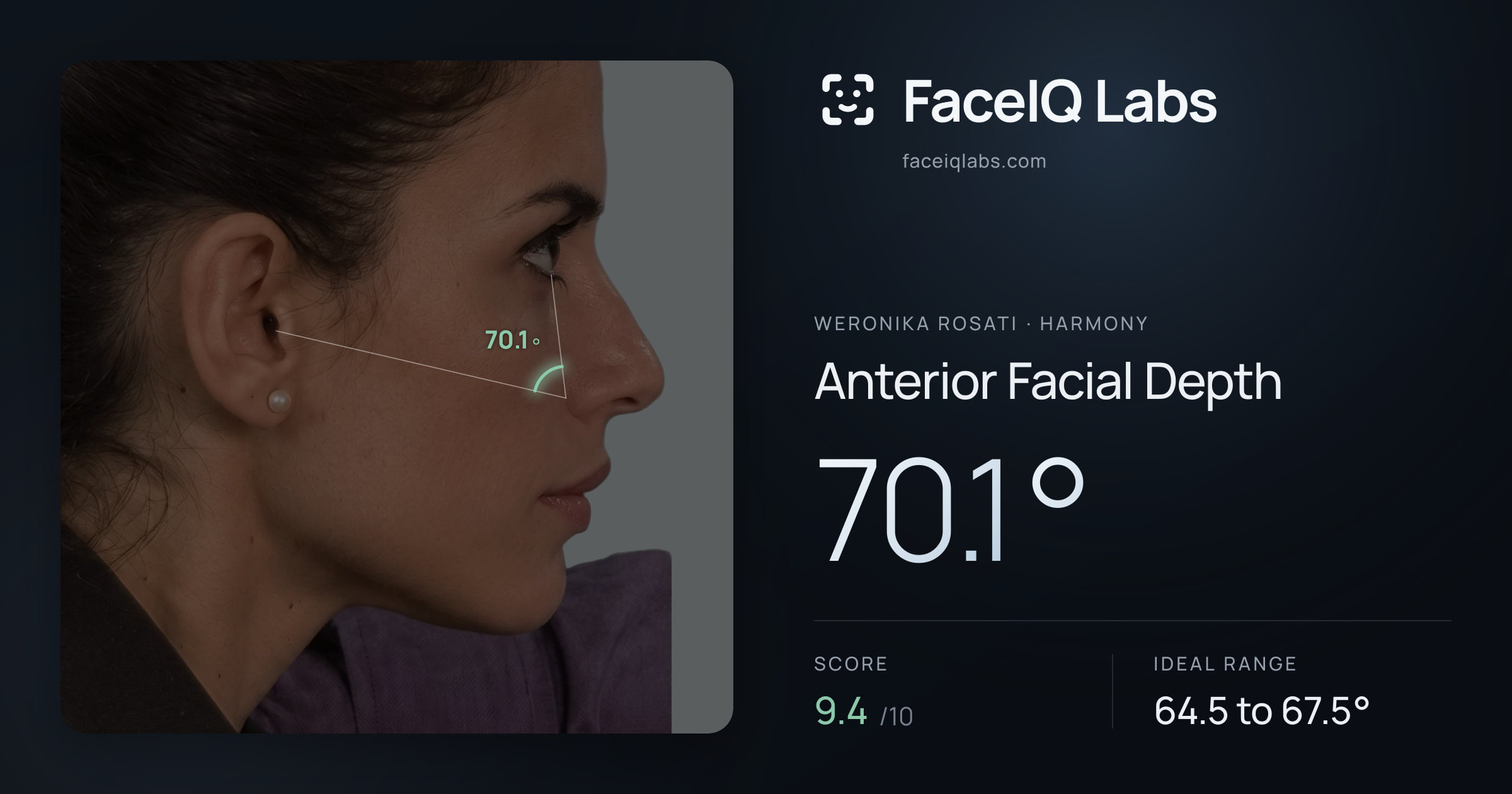 Weronika Rosati Anterior Facial Depth: 70.1°, drawn on the photo