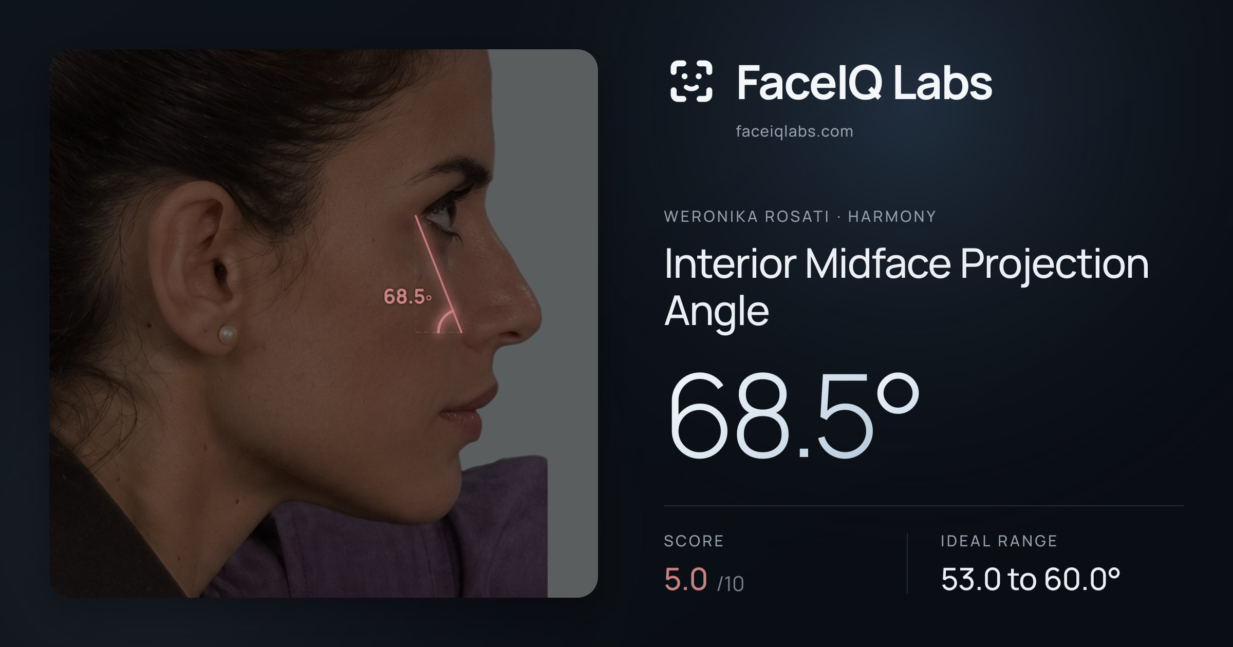 Weronika Rosati Interior Midface Projection Angle: 68.5°, drawn on the photo